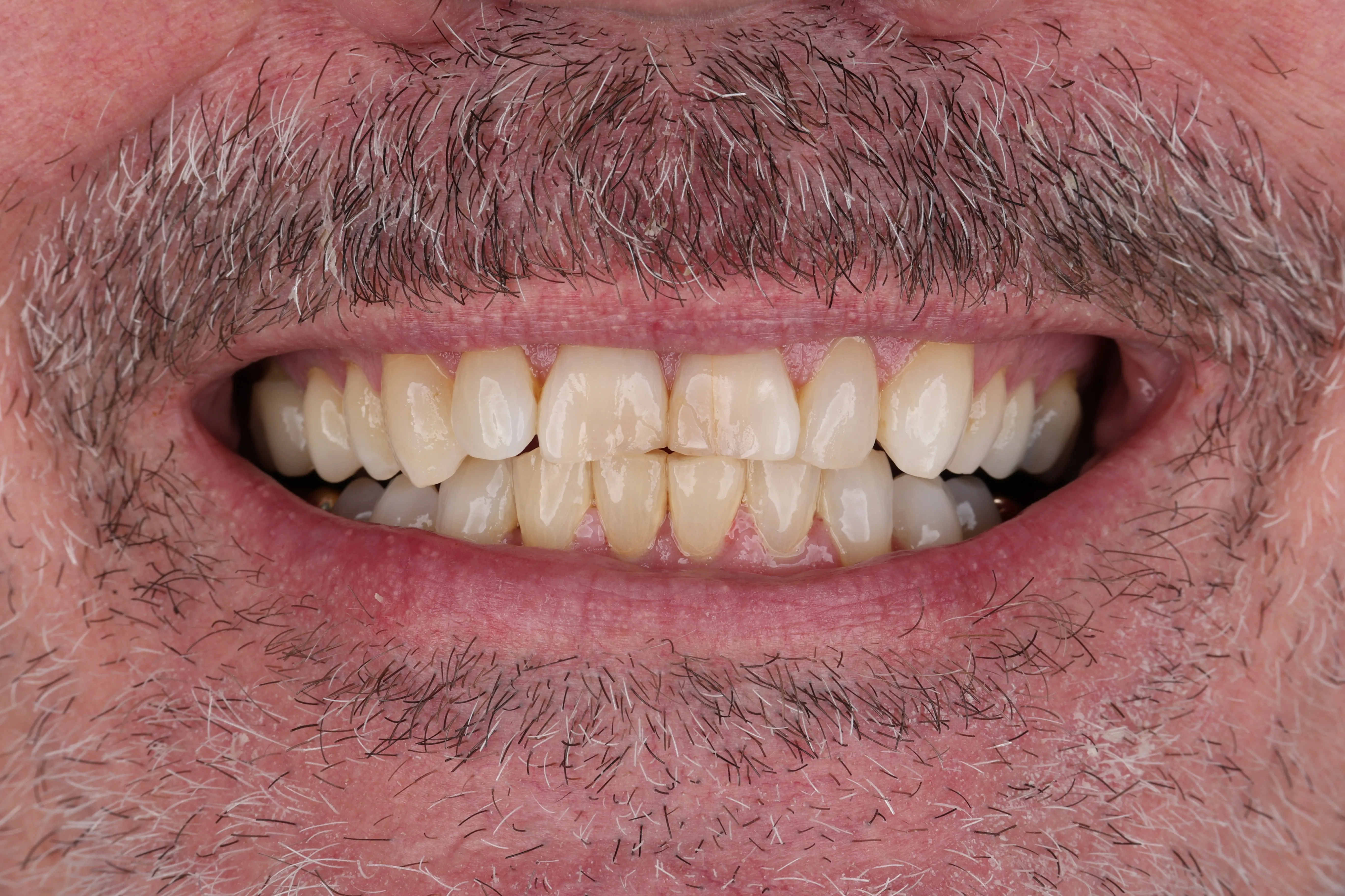 Dental evaluation for tooth extraction at Livewell Dental