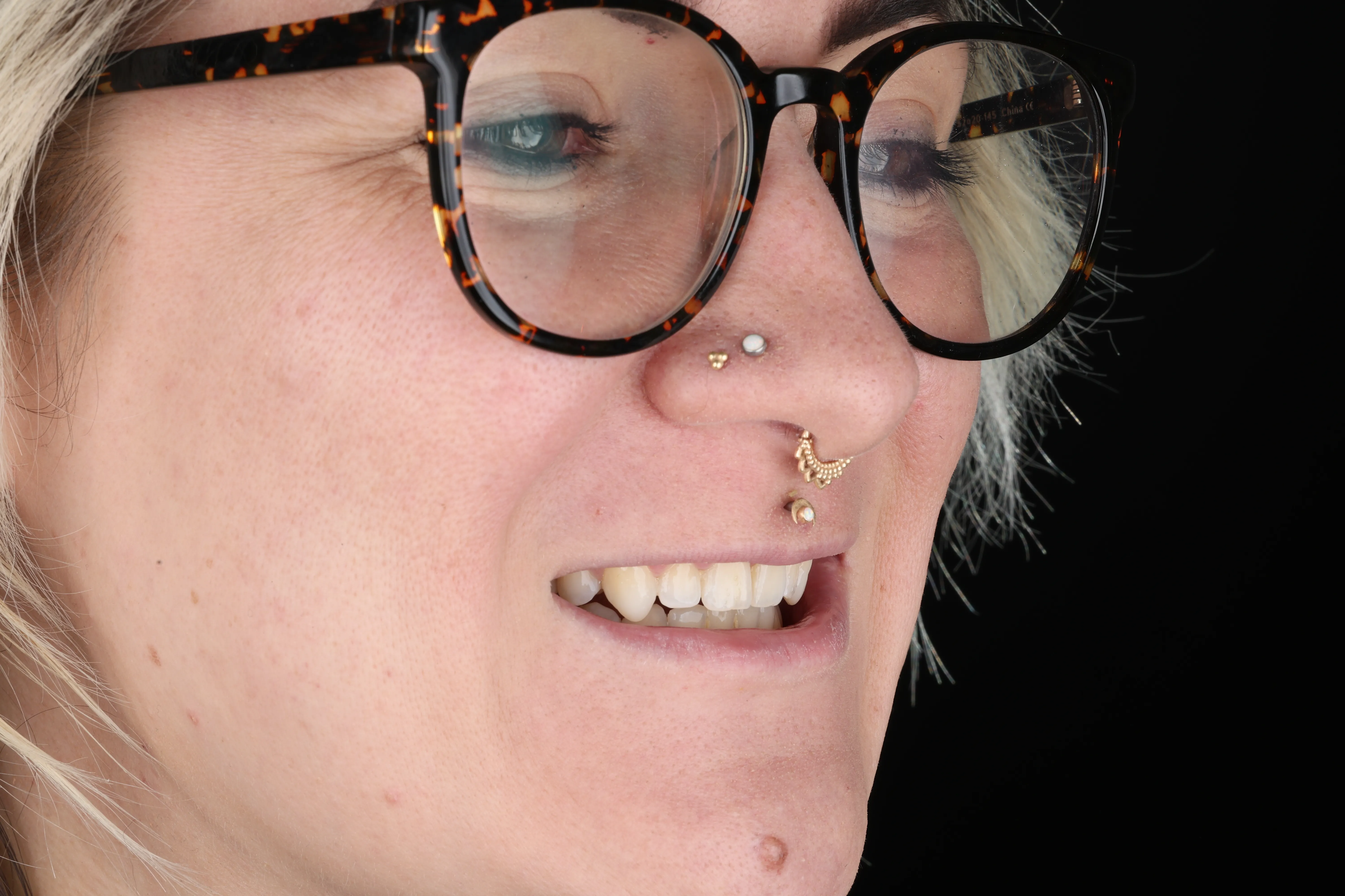 Before photo showing gum line concern before treatment at Livewell Dental