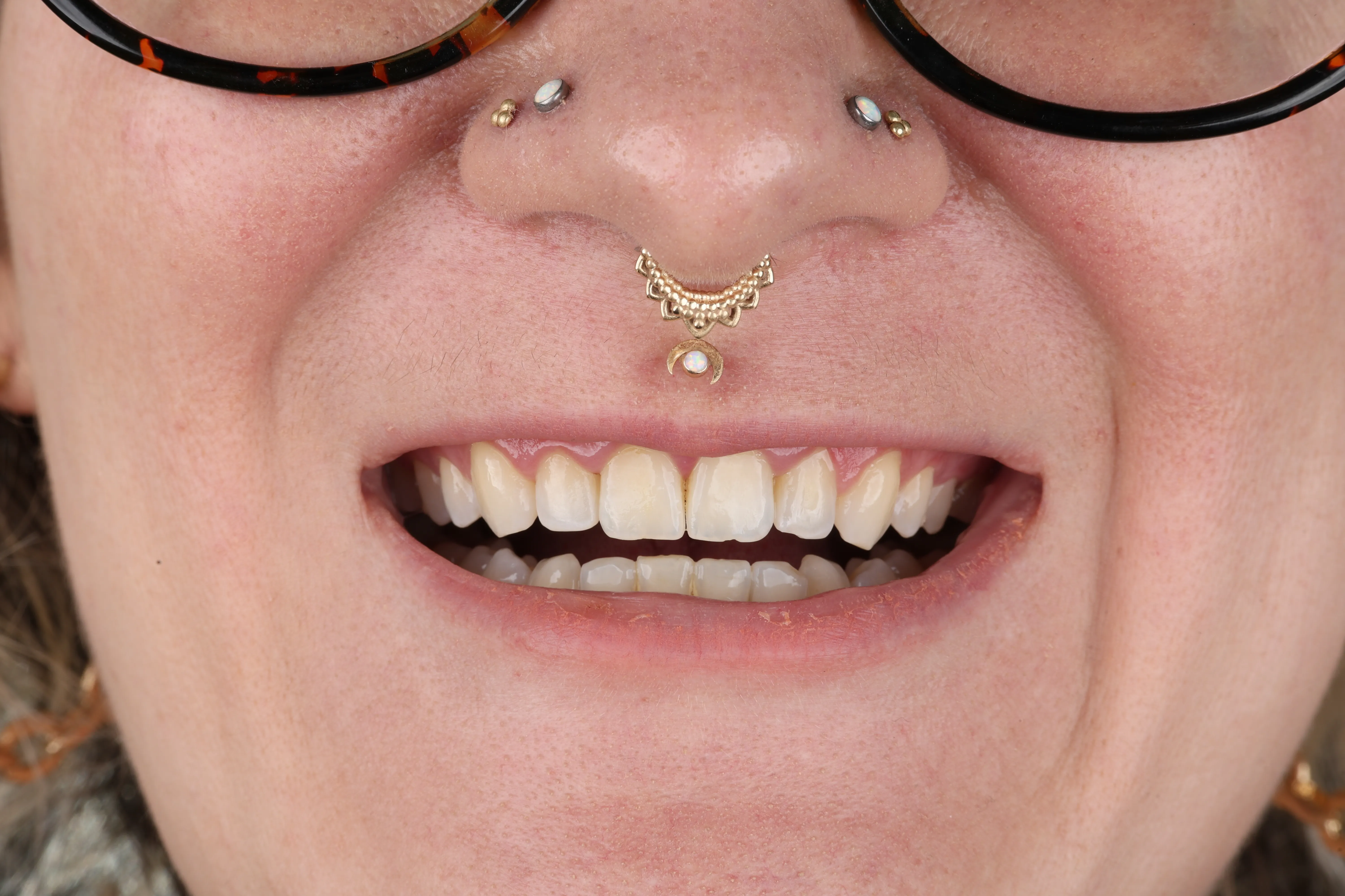 Before photo showing gum recession and bonding case at Livewell Dental