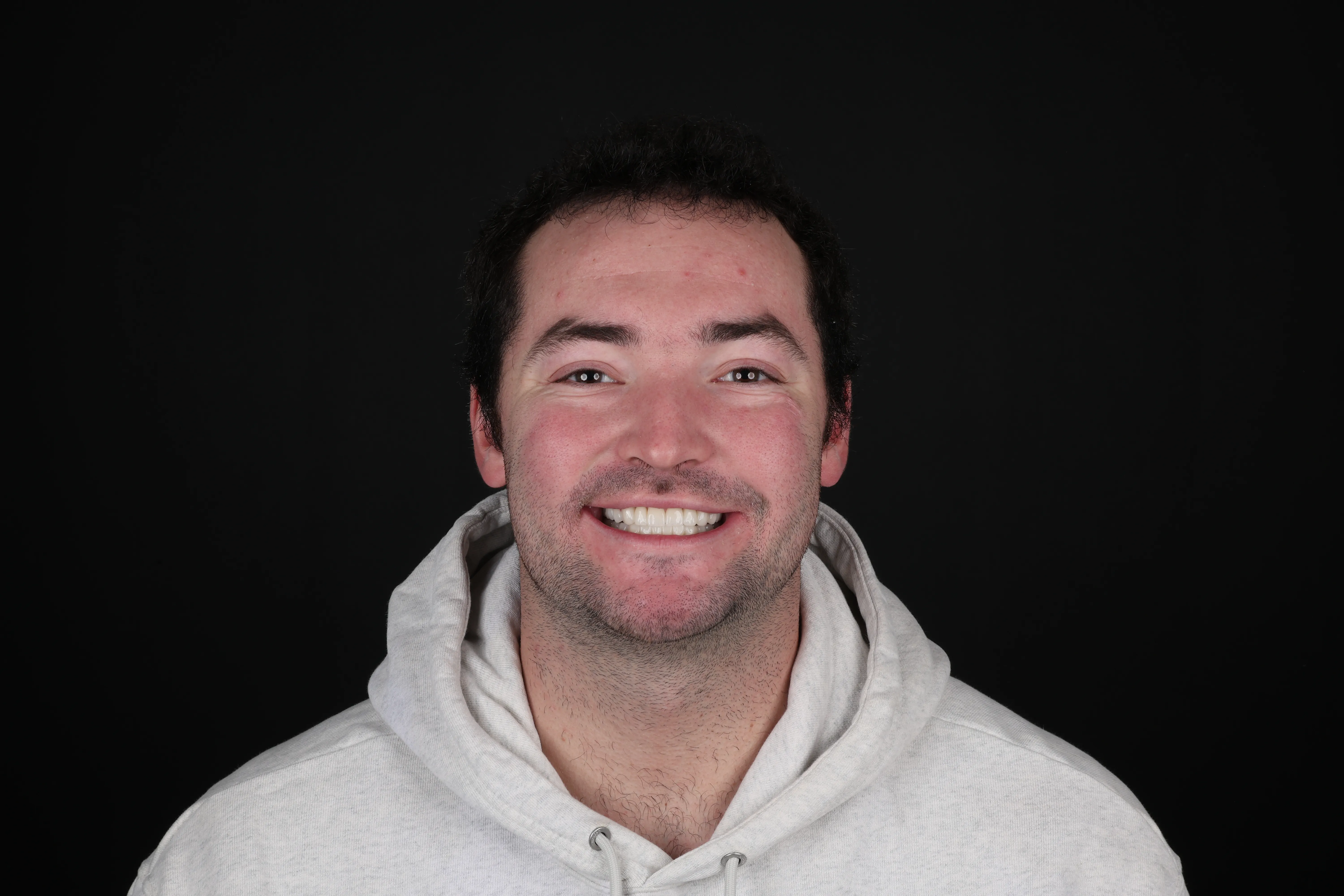 After full-mouth reconstruction with implant, crowns, and gum surgery at Livewell Dental