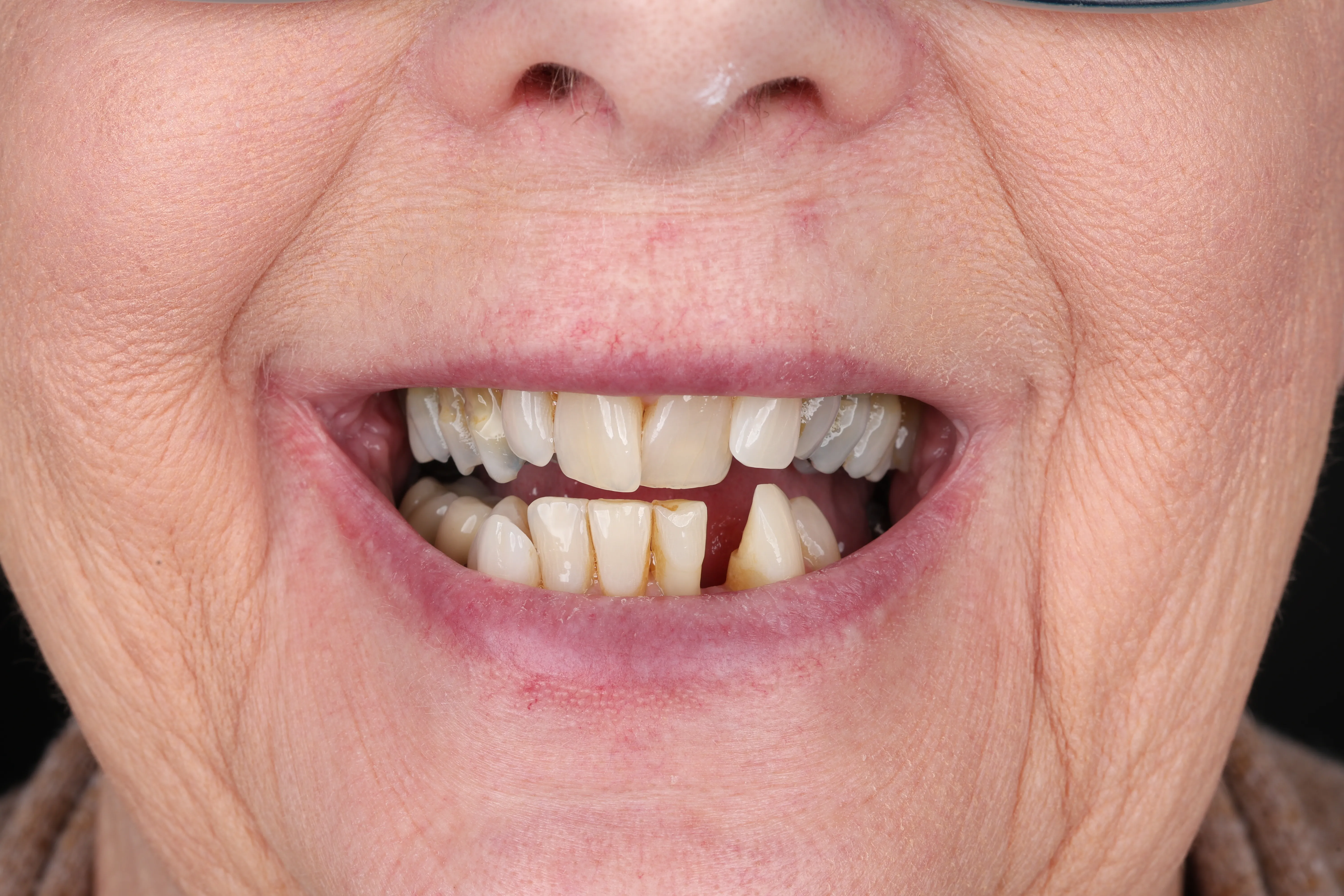 Patient consultation for bone grafting and dental implant planning at Livewell Dental