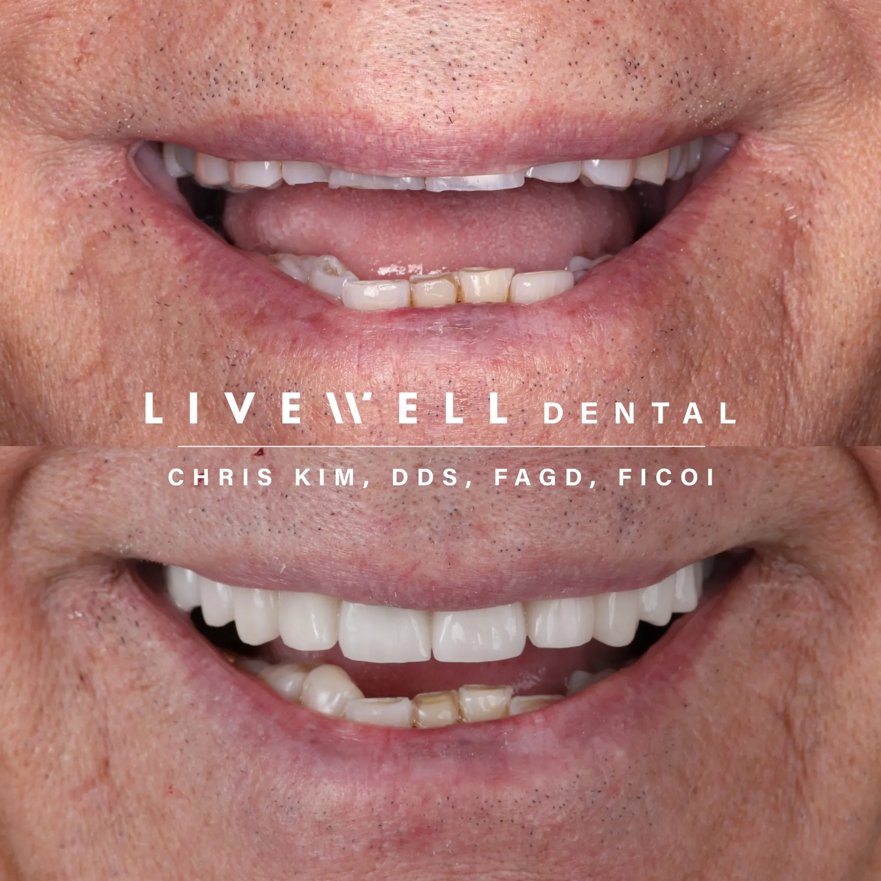 Ten upper teeth, harmonized to perfection. Balanced, bright, and confident — ready for any setting, any angle, any moment.