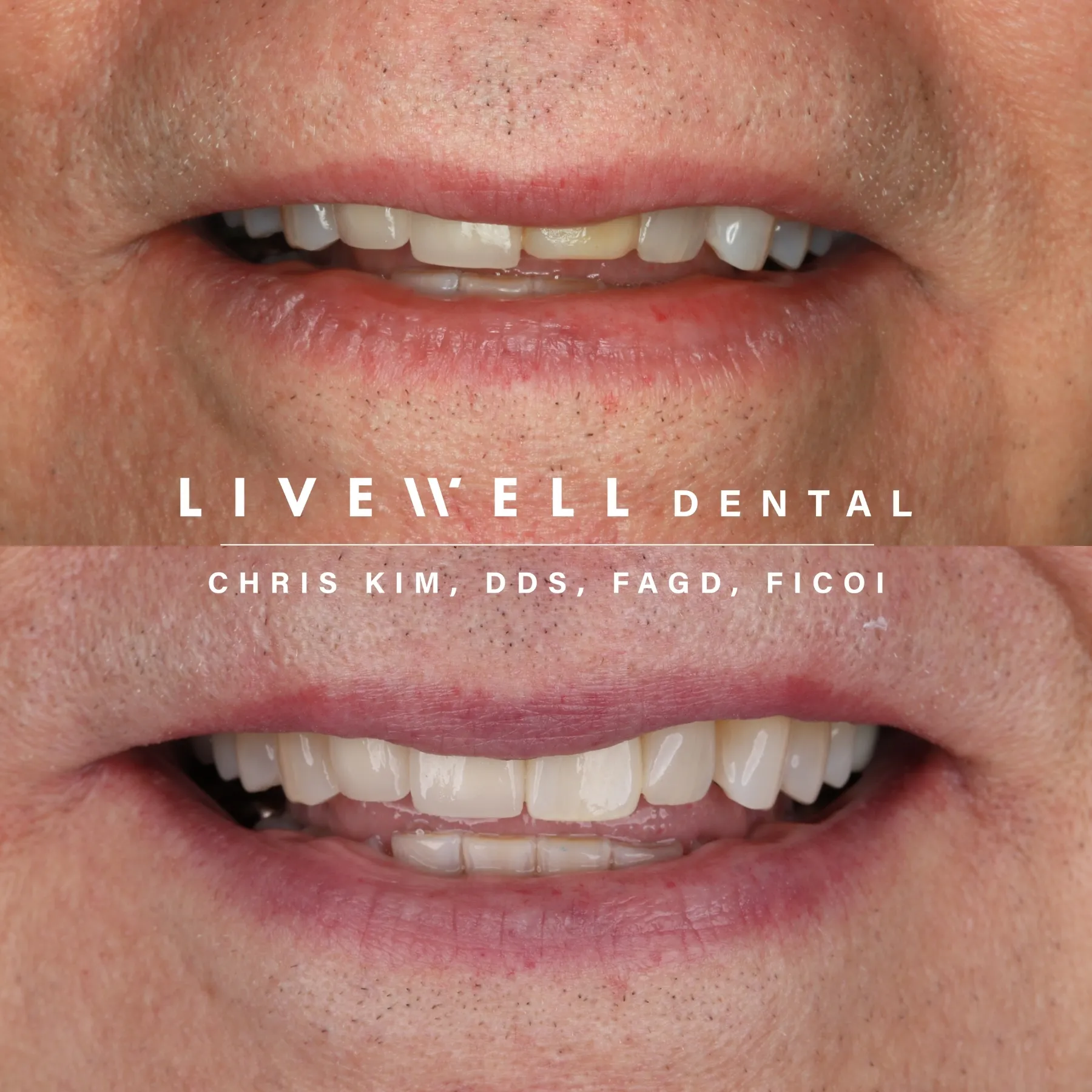 Ten upper teeth, harmonized to perfection. Balanced, bright, and confident — ready for any setting, any angle, any moment.