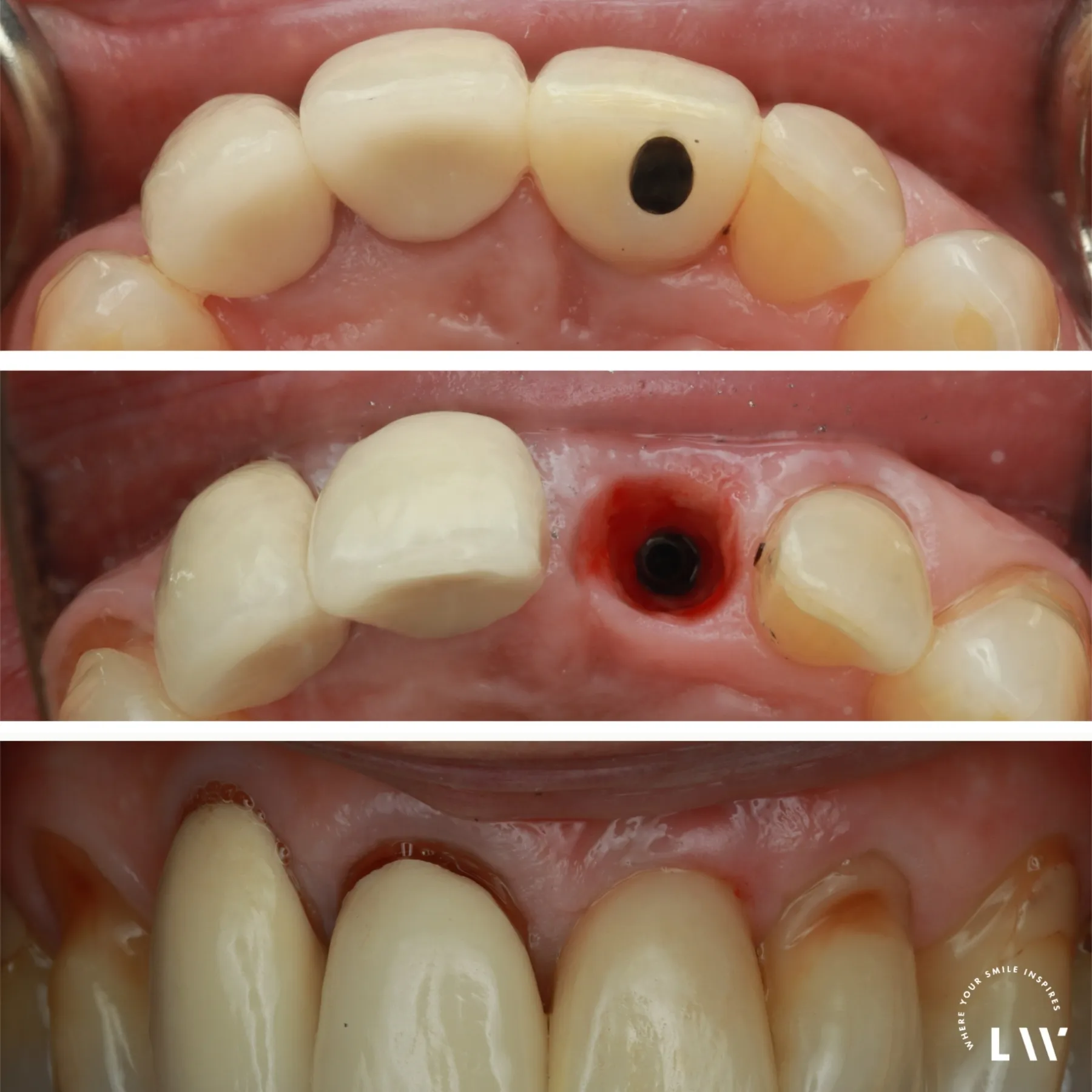 Single dental implant case at Livewell Dental