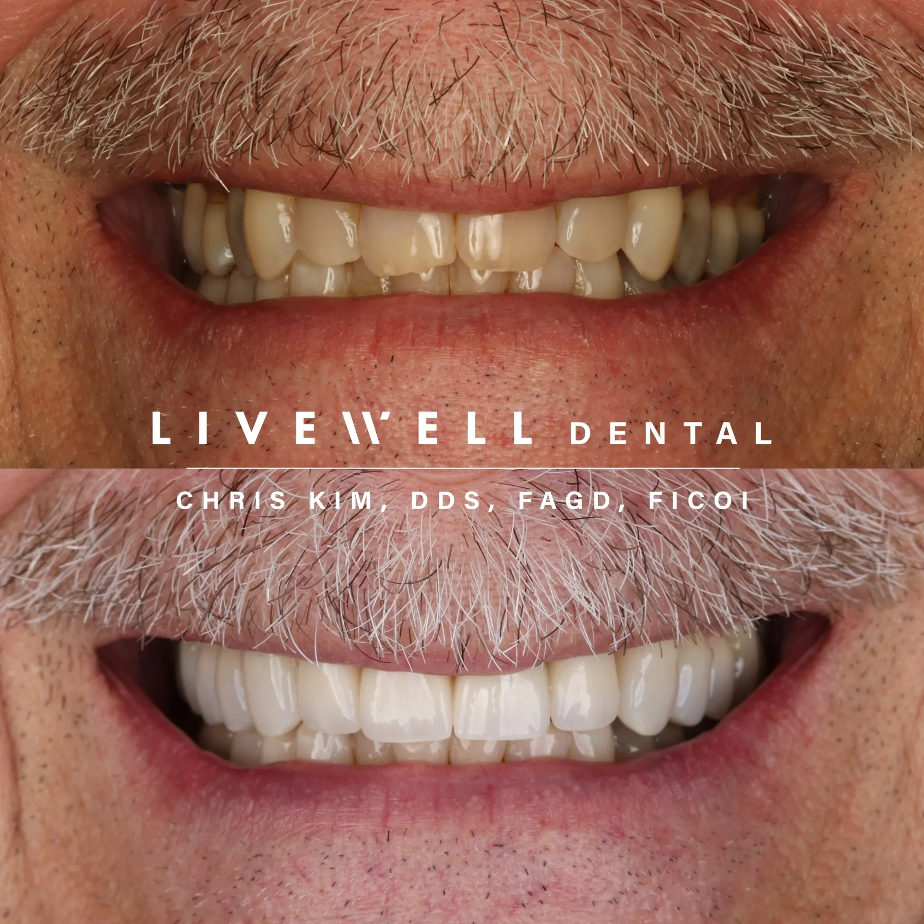 Smile makeover and whitening result at Livewell Dental