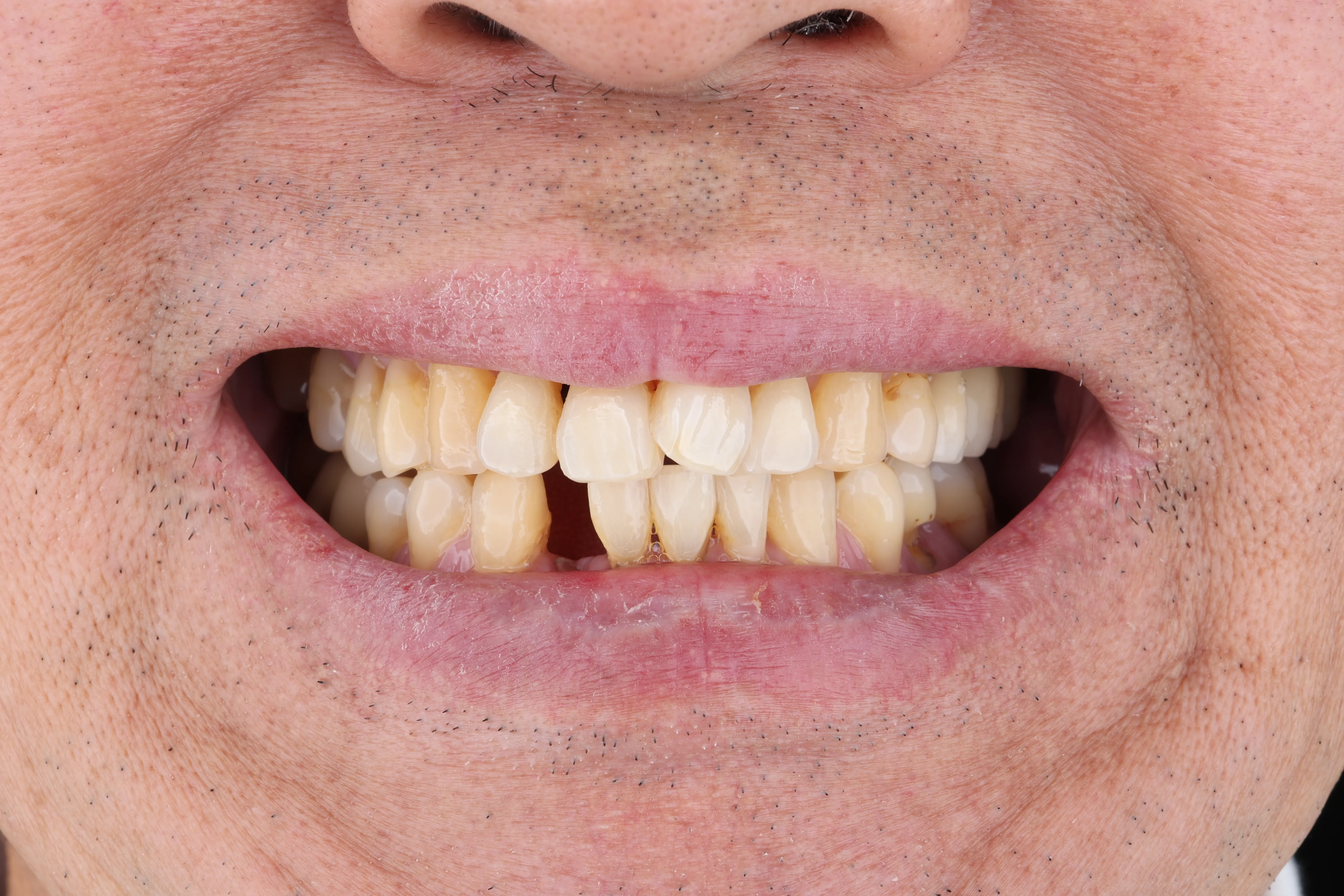 Patient consultation for ridge augmentation and dental implant planning at Livewell Dental