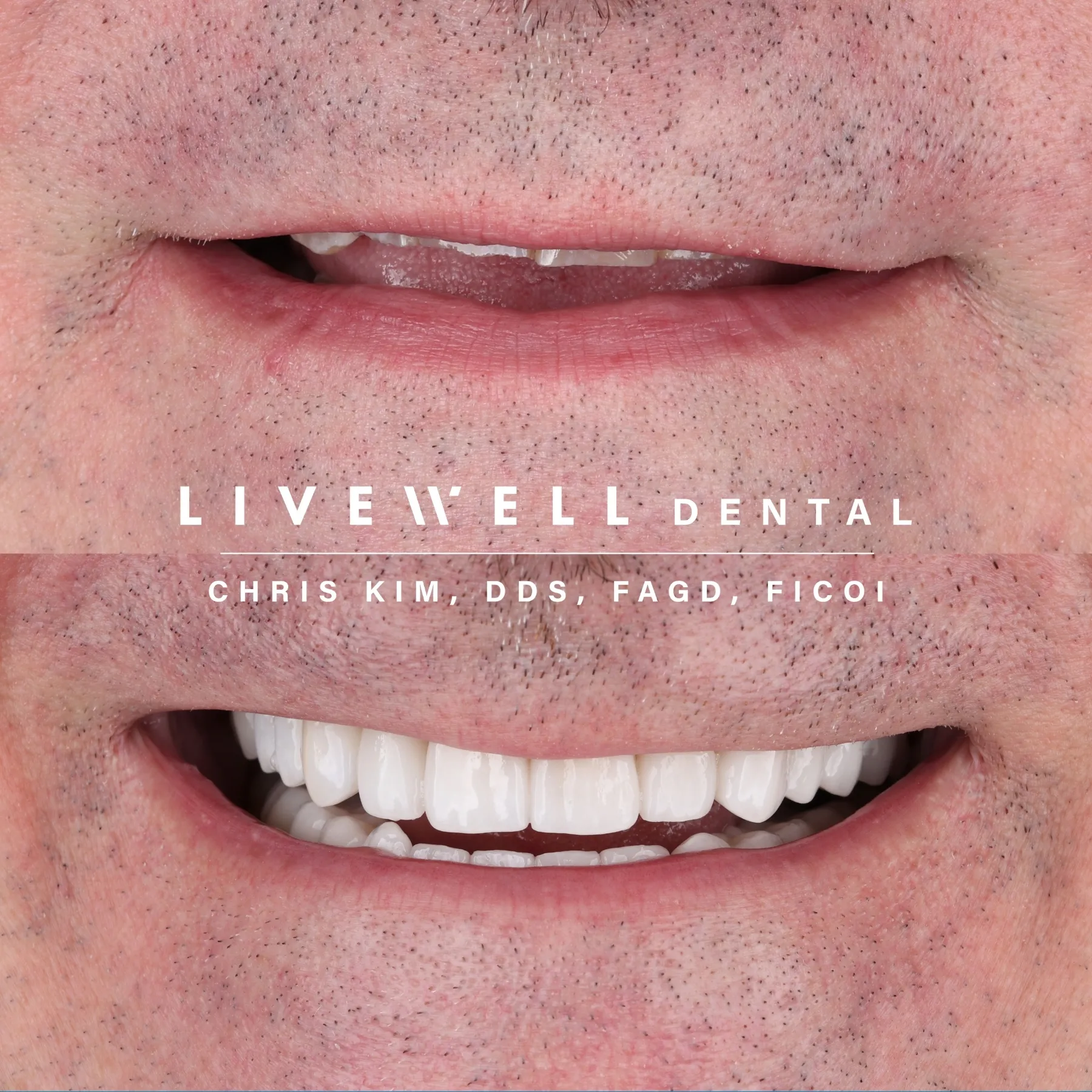 After inlay or onlay restorative dentistry treatment at Livewell Dental
