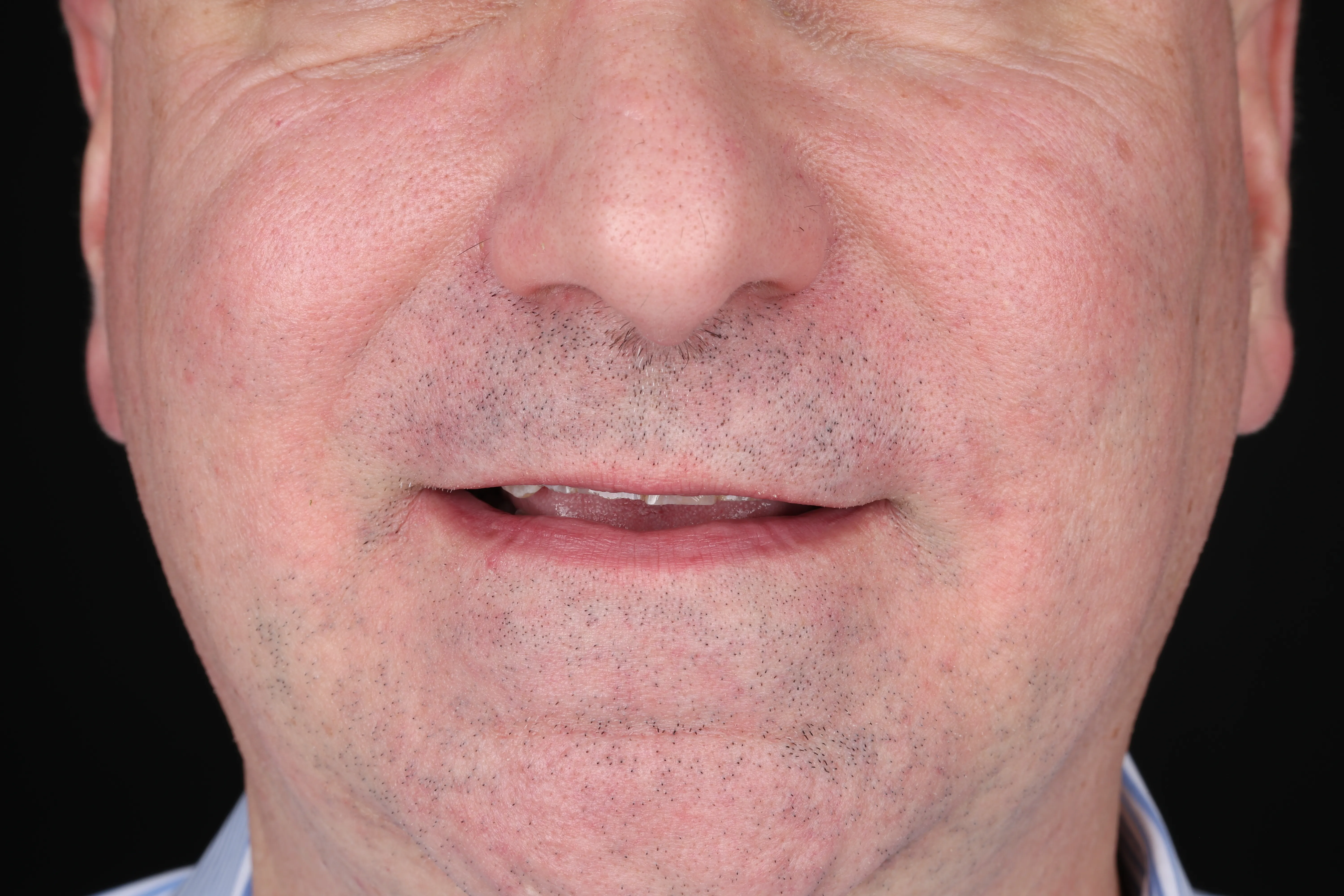 Before restorative dentistry treatment for worn and damaged teeth