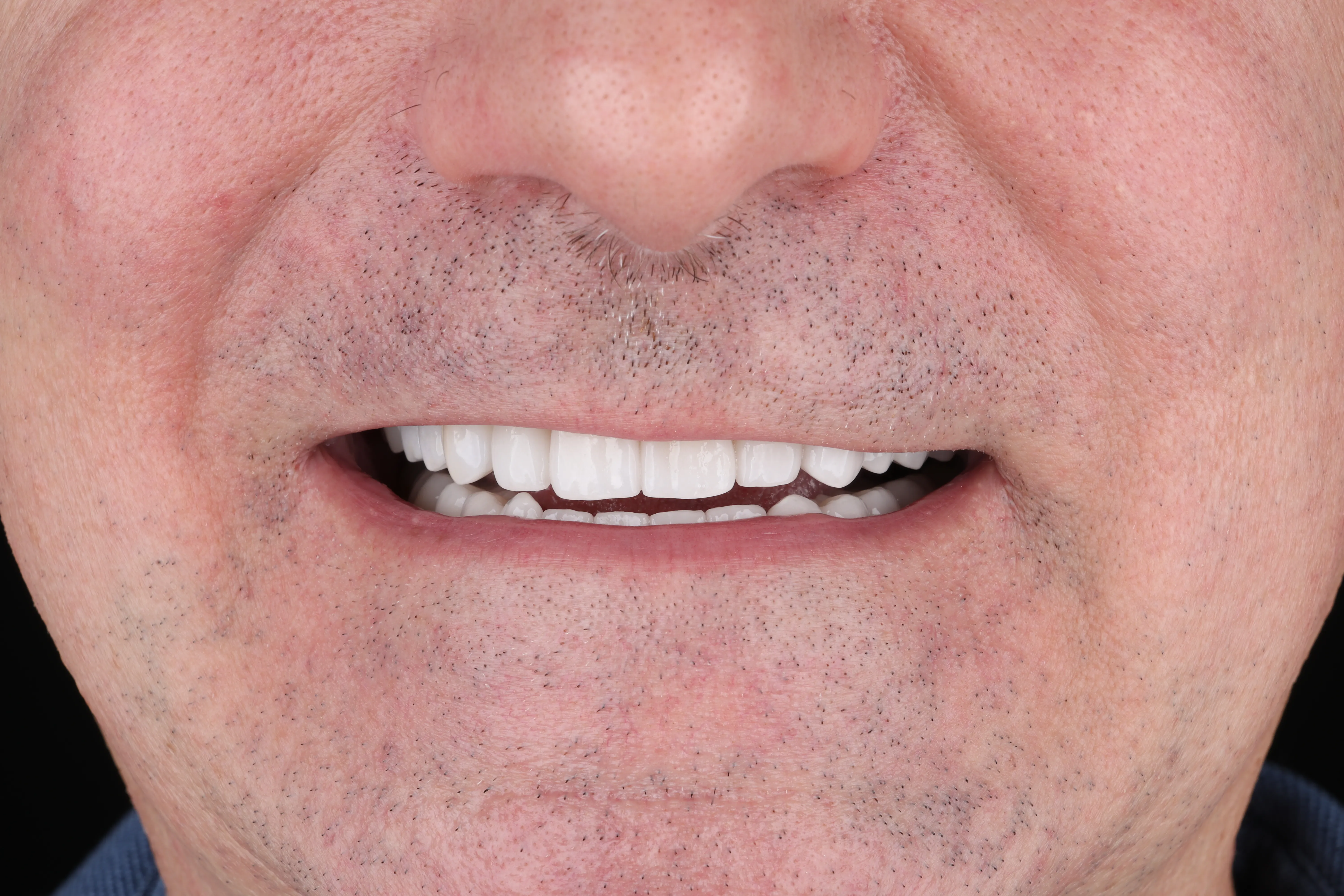 After restorative dentistry result with inlays, onlays, or crowns at Livewell Dental