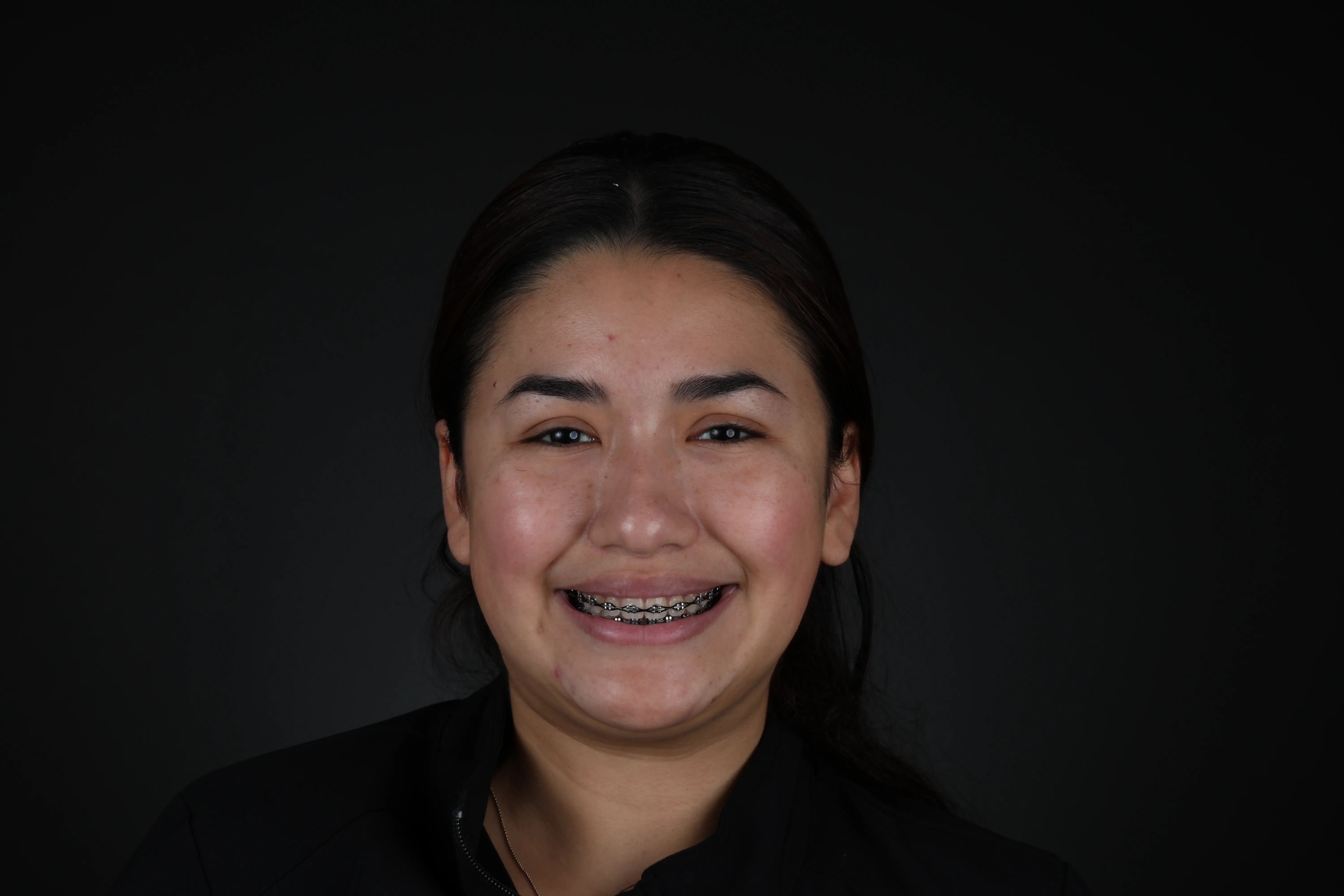 Dental braces case result at Livewell Dental in Fairfax Station, VA