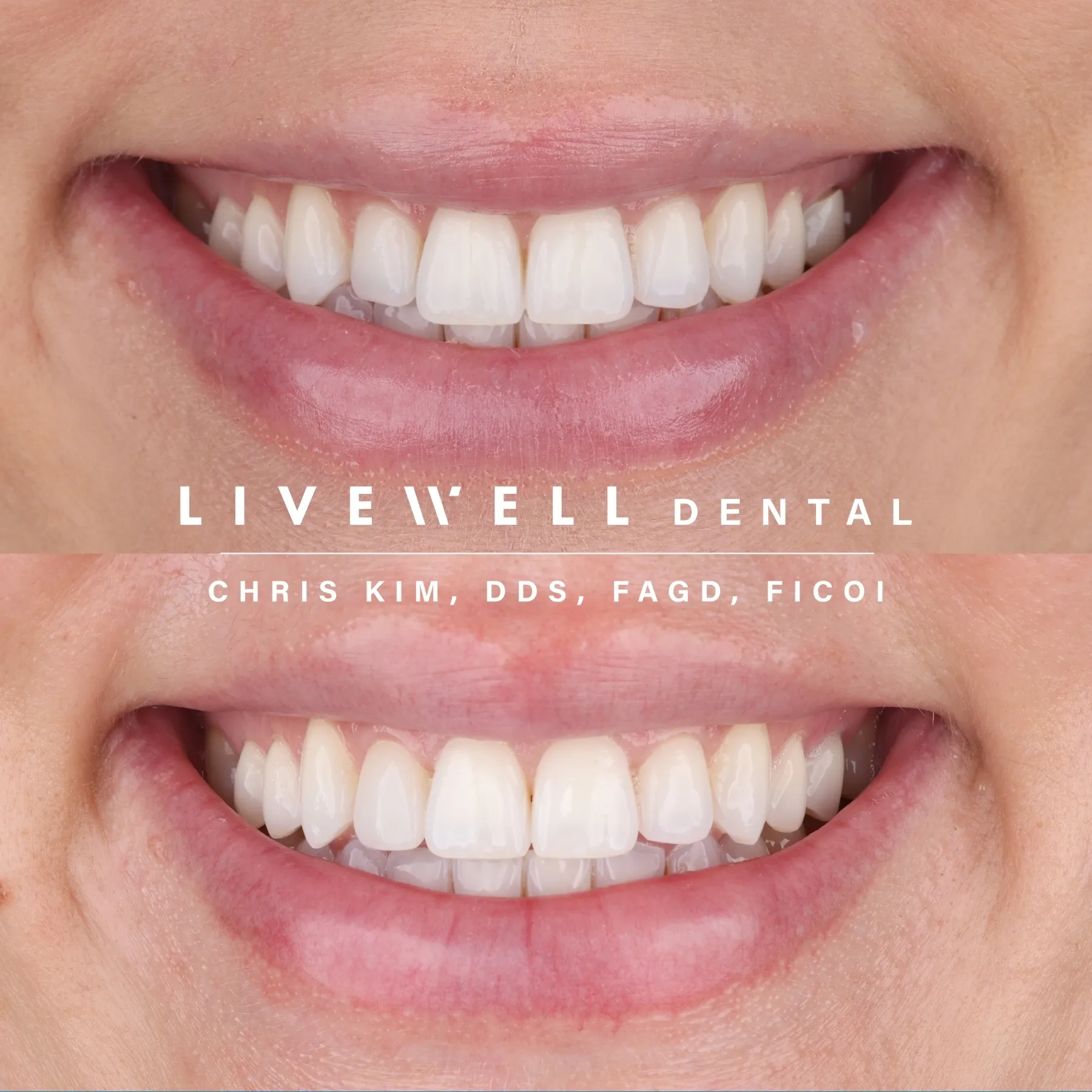 Four front teeth. One magical transformation. Ideal for fixing wear, discoloration, or imbalance in the most visible zone of your smile.