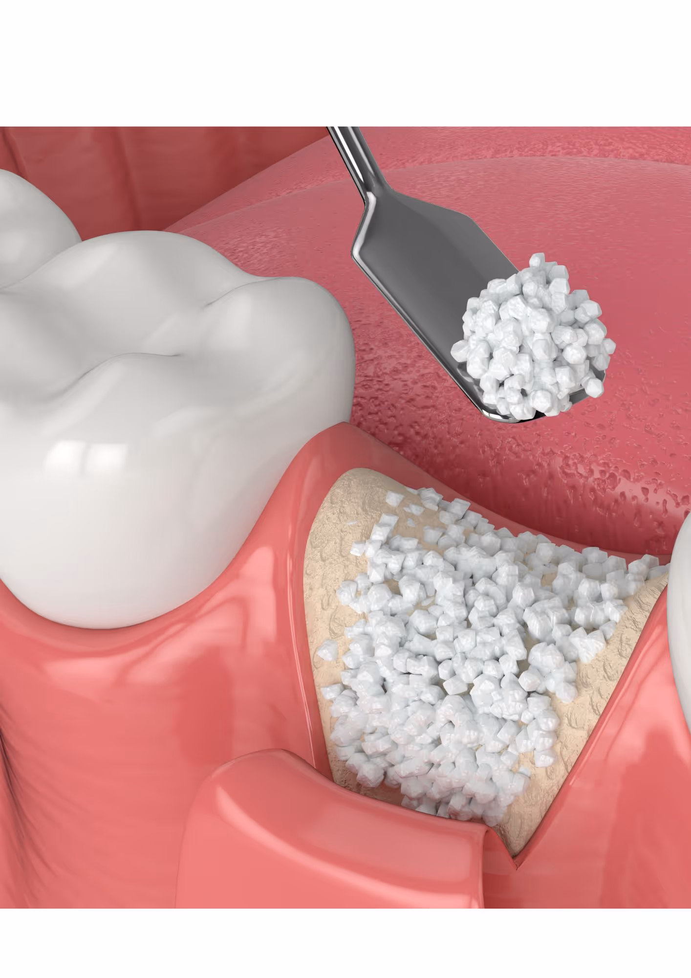 Bone grafting treatment planning at Livewell Dental