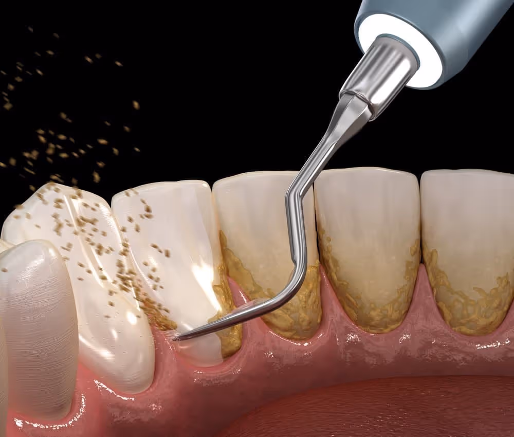 Scaling and root planing treatment for gum disease at Livewell Dental, Fairfax Station, VA