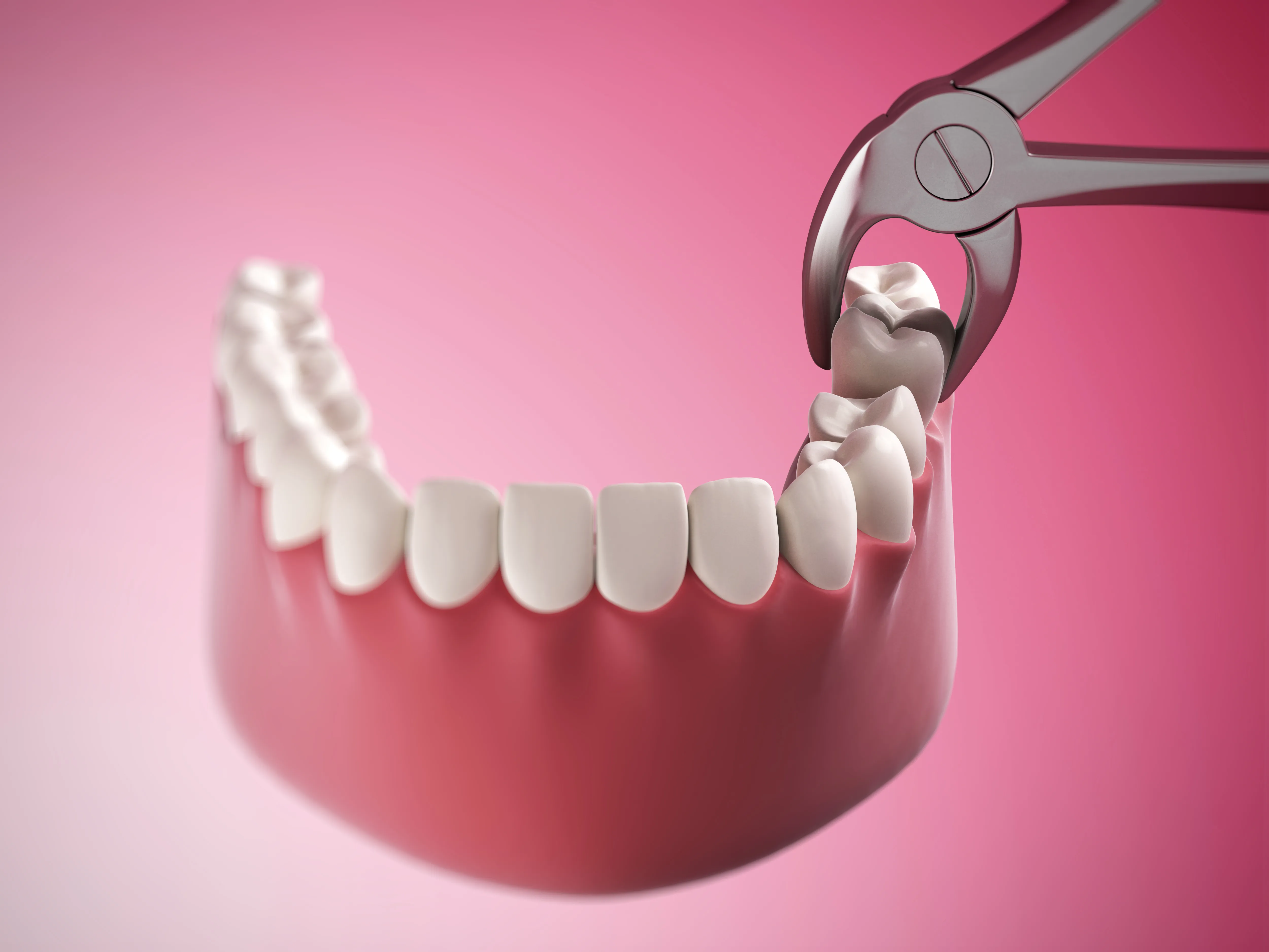 tooth removal illustration