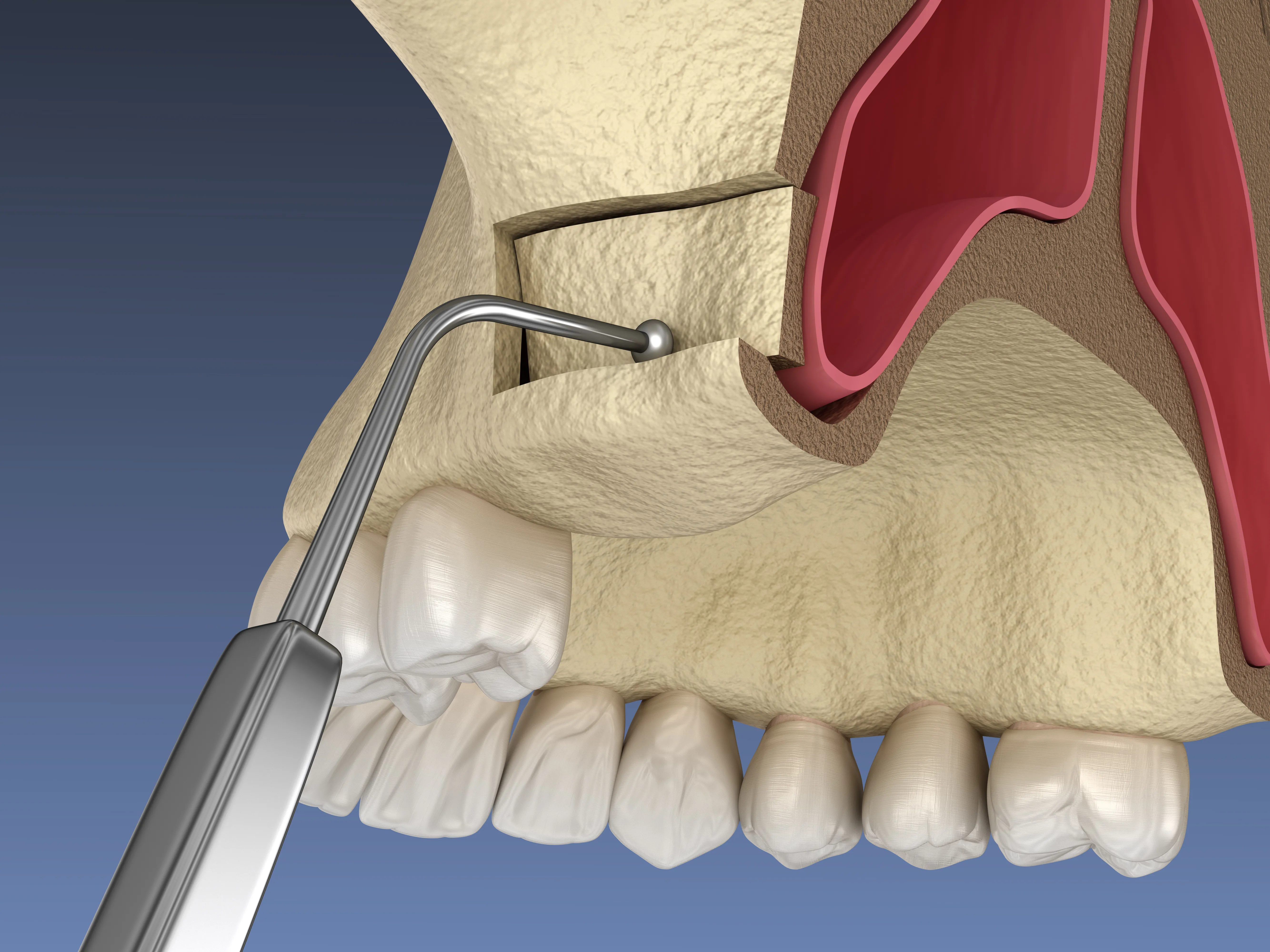 Cross-section diagram showing sinus lift bone grafting for dental implants