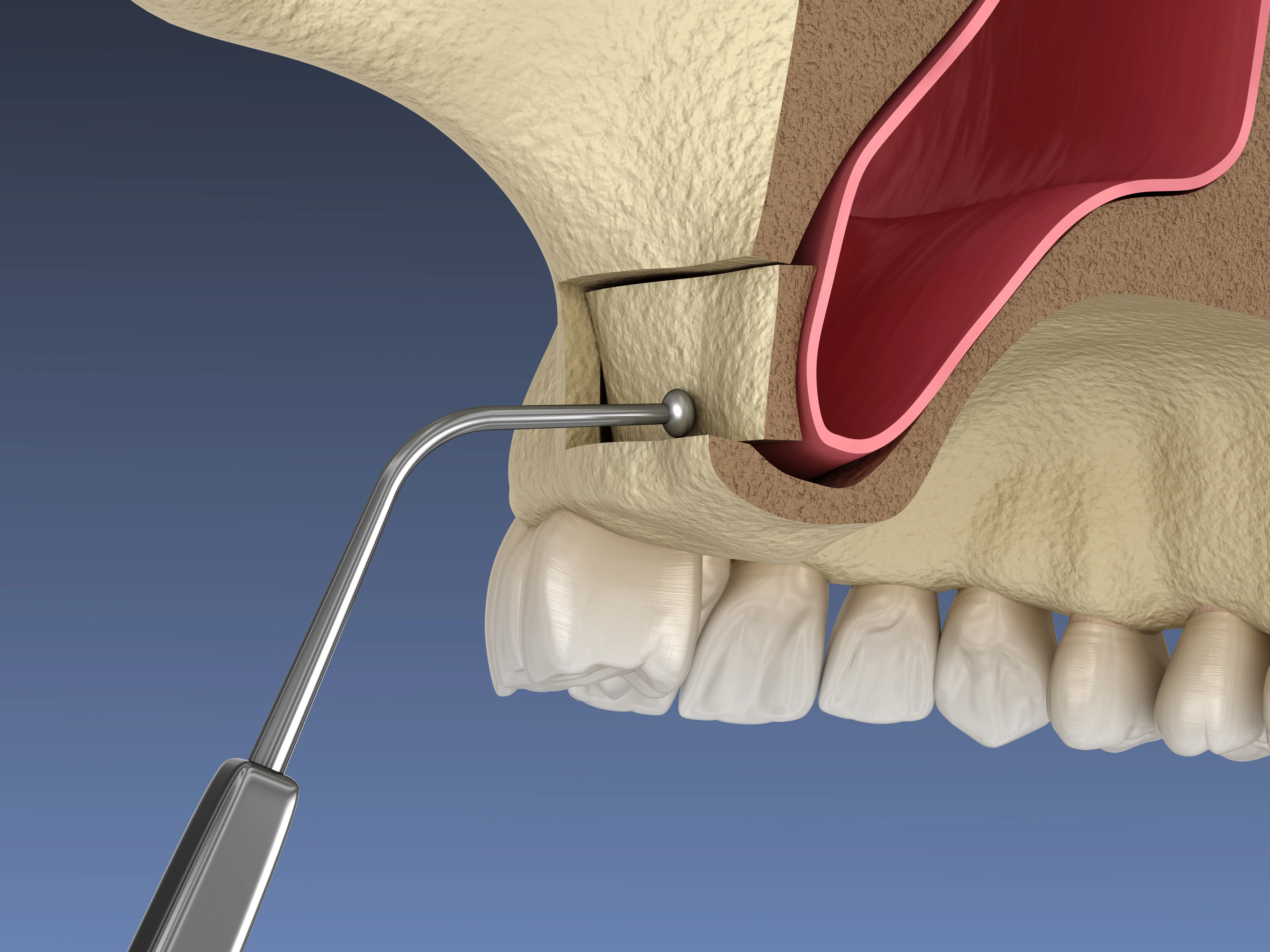 Sinus lift treatment illustration for dental implants
