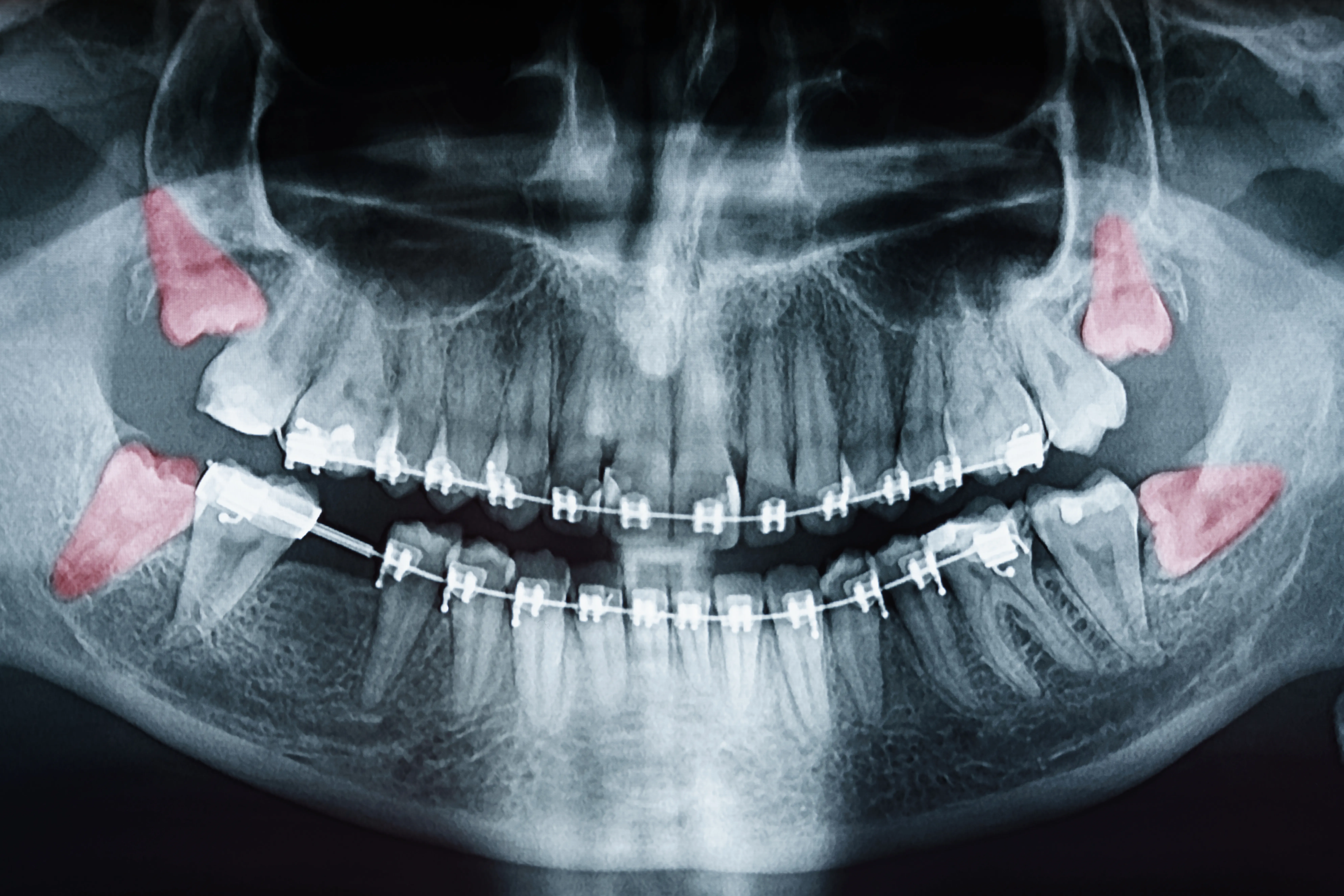 Wisdom teeth removal procedure