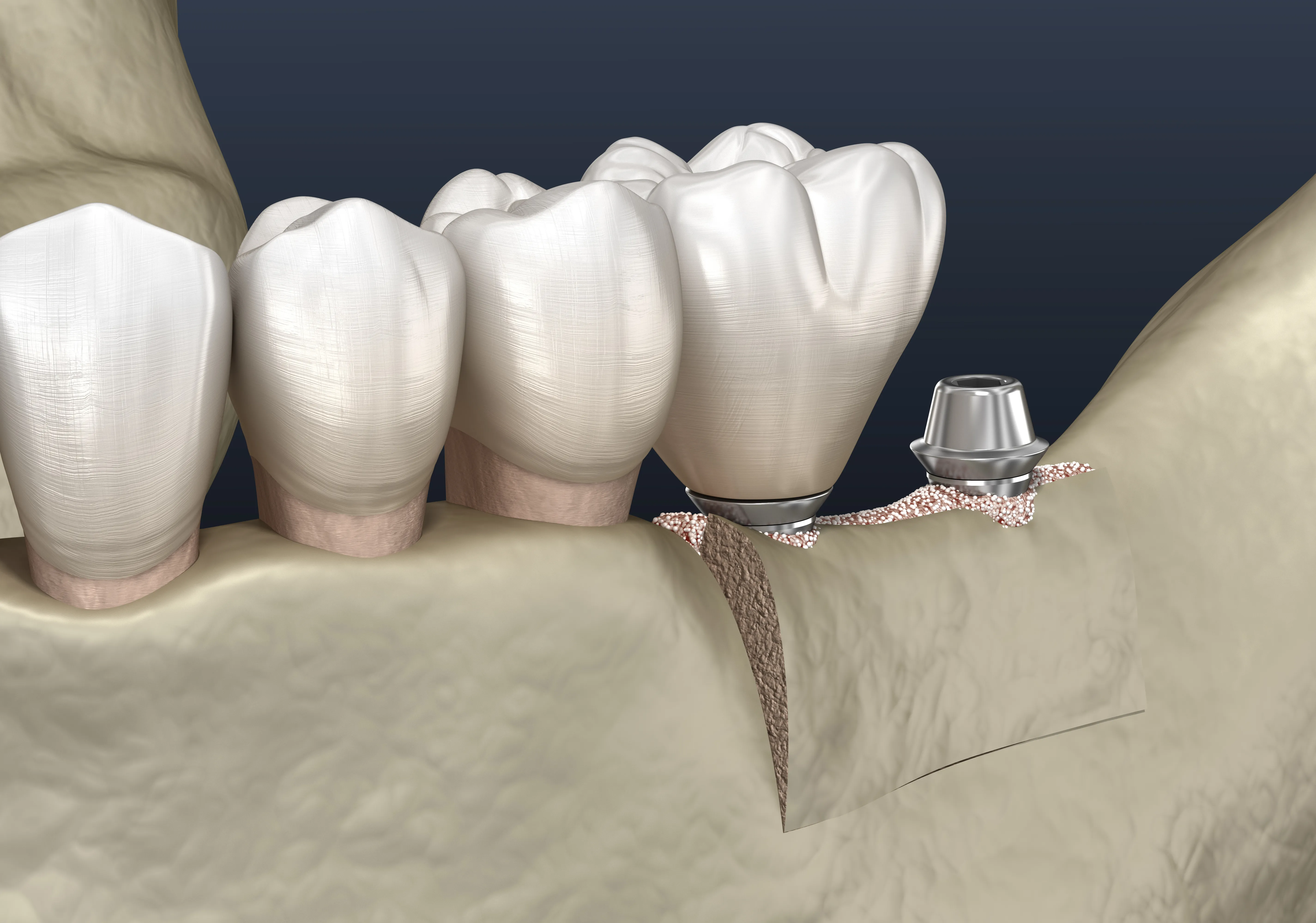 Ridge augmentation treatment illustration for dental implant planning