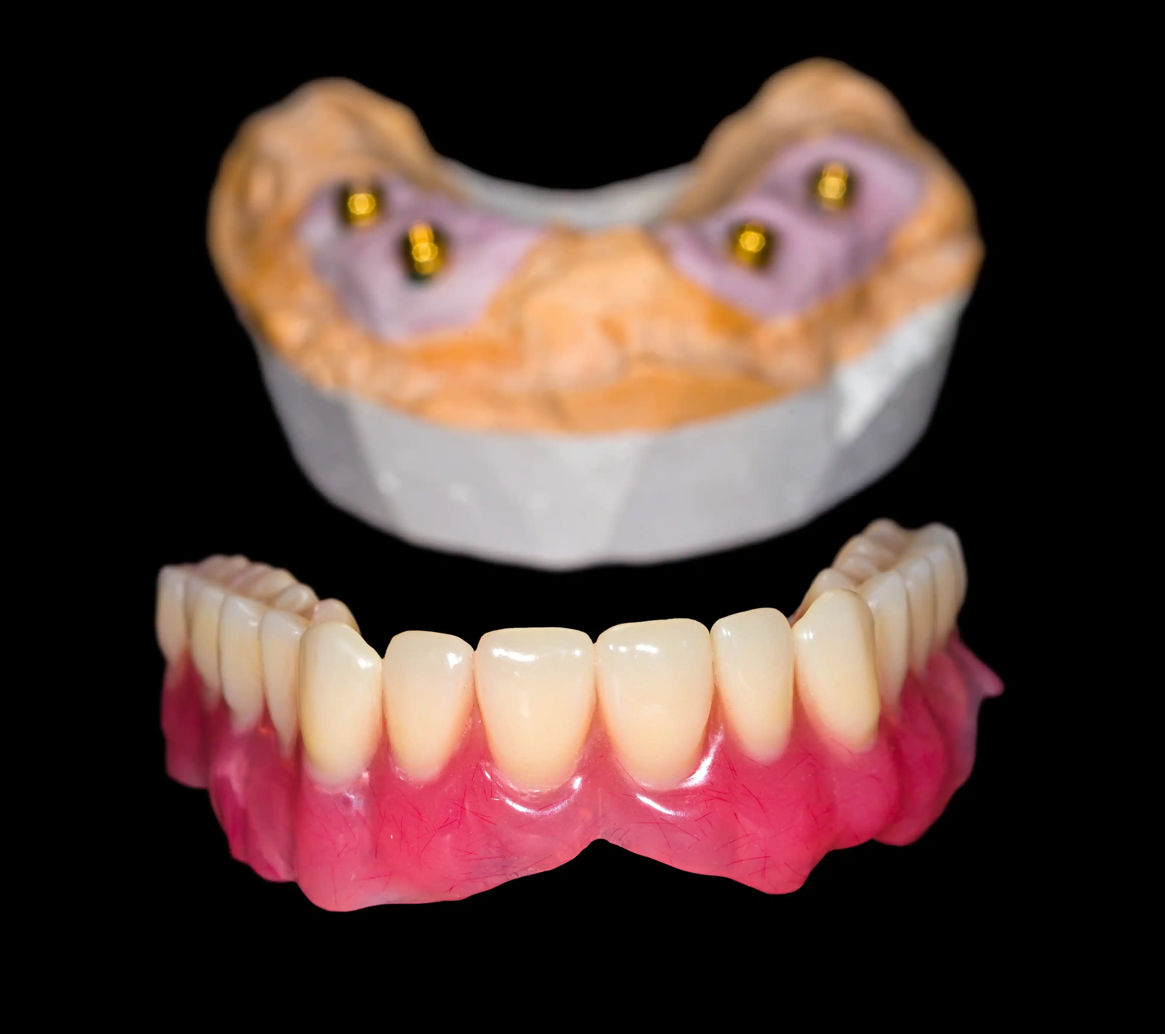Removable locator-retained denture attached to dental implants