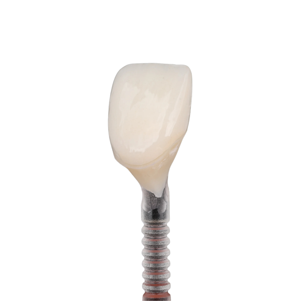 Diagram showing an implant-supported bridge with implants and bridge restoration