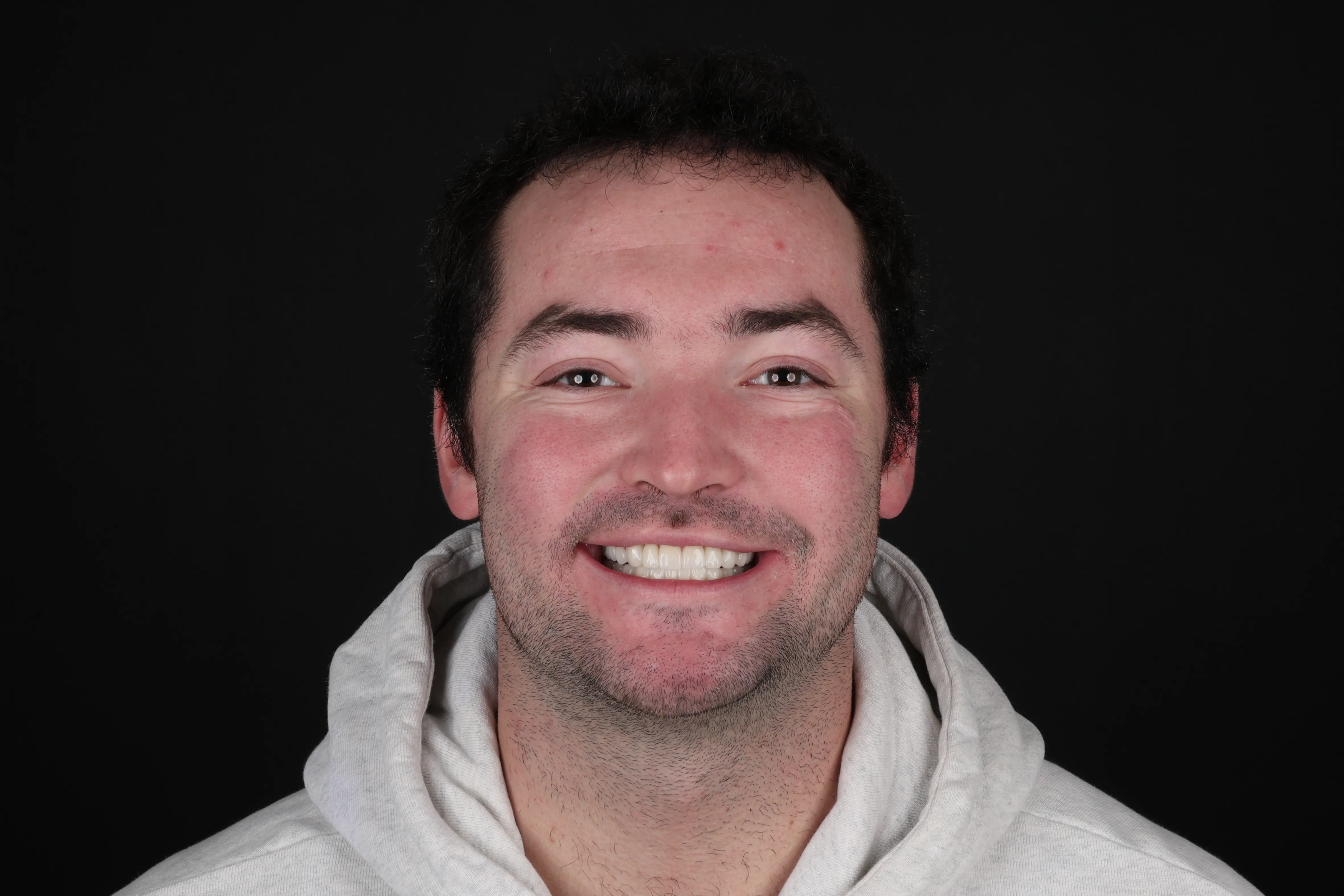 After full-mouth reconstruction with implant, crowns, and gum surgery at Livewell Dental