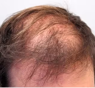 Foto hoofdhuid voor Fellos haaruitval behandeling met finasteride of minoxidil