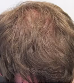 Foto hoofdhuid na Fellos haaruitval behandeling met finasteride of minoxidil
