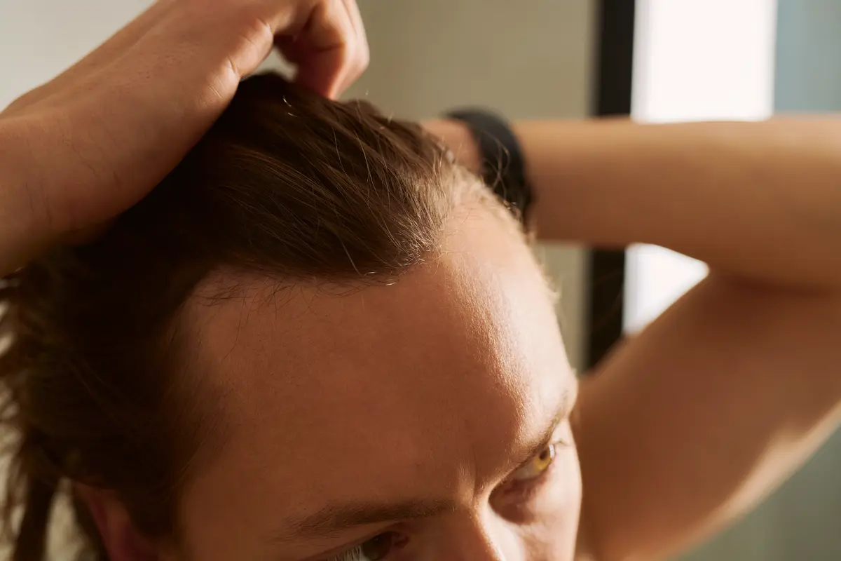 Was ist Alopezie? Erkennen Sie die Form und behandeln Sie gezielt mit Fellos
