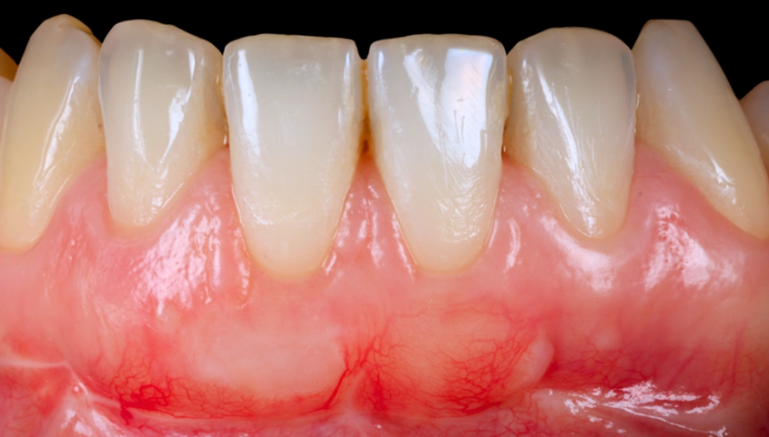 Résultat après la greffe gingivale
