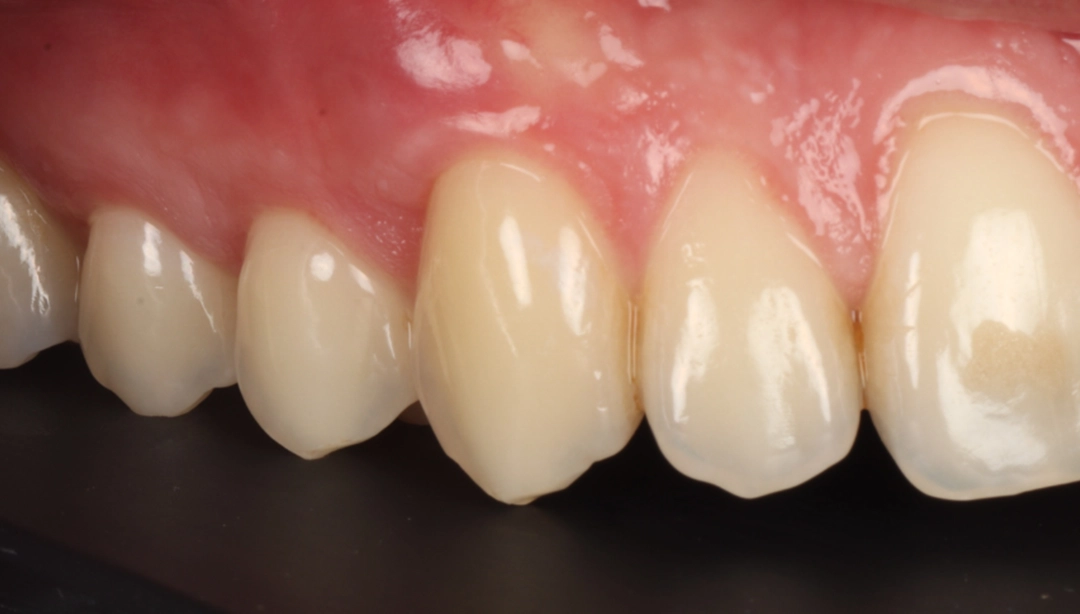Résultat après une greffe gingivale. 