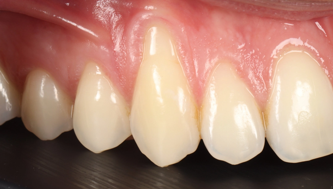 Gencive enflammée et rétractée autour d'une dent avec inflammation visible.