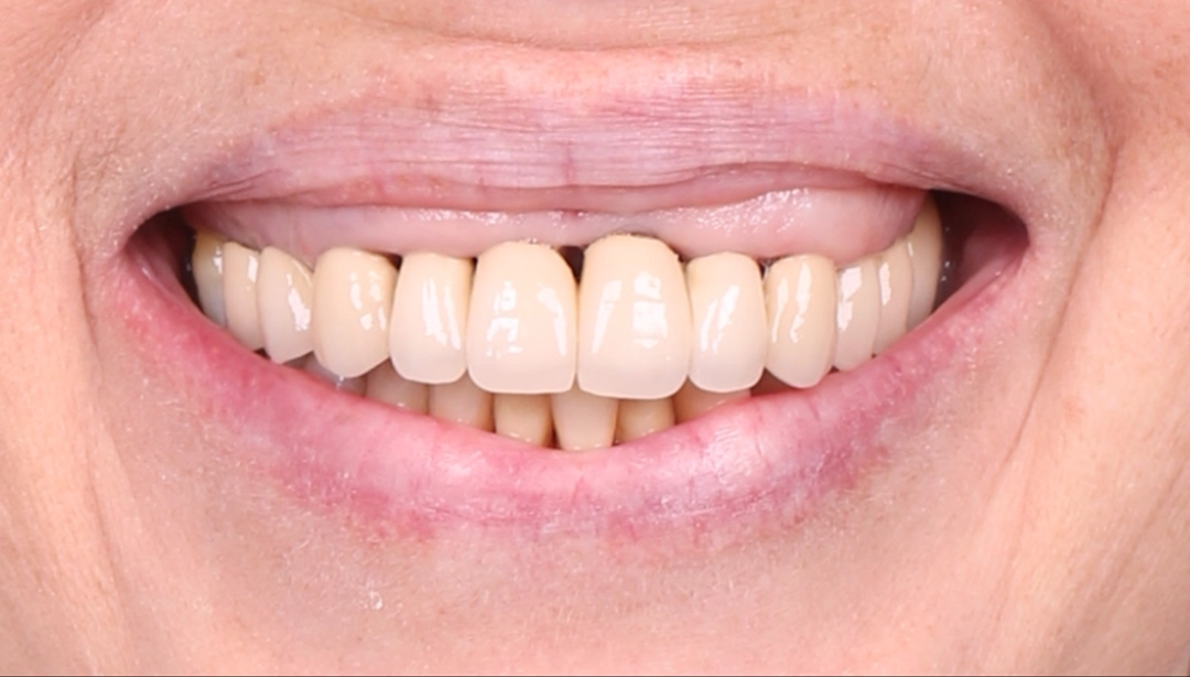 Des dents supérieures endommagées par une maladie parodontale