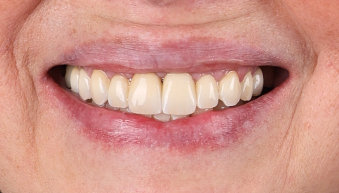Résultat après la pose de 8 implants, un sourire avec un résultat esthétique