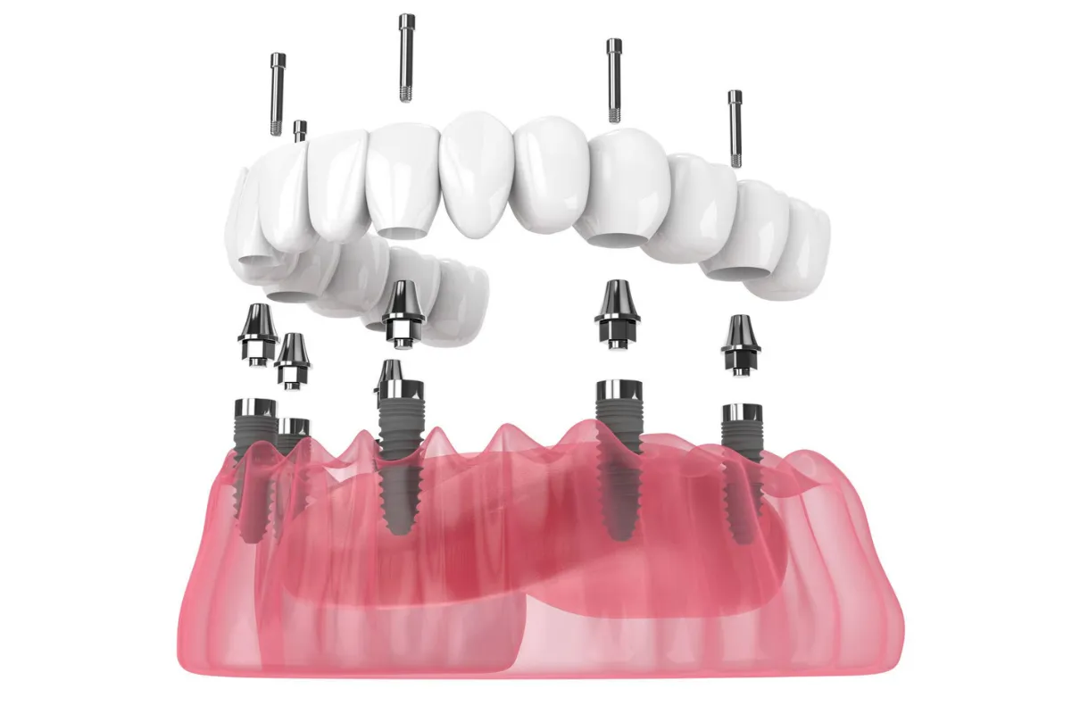 Illustration montrant une prothèse dentaire complète fixée par des implants dans la mâchoire inférieure.