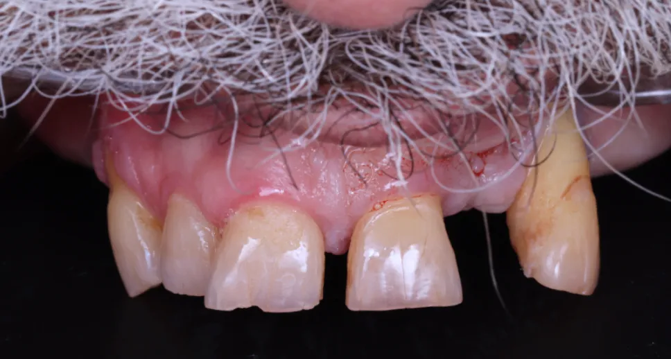 Patient présentant des absences dentaires et des dents en mauvaise état.