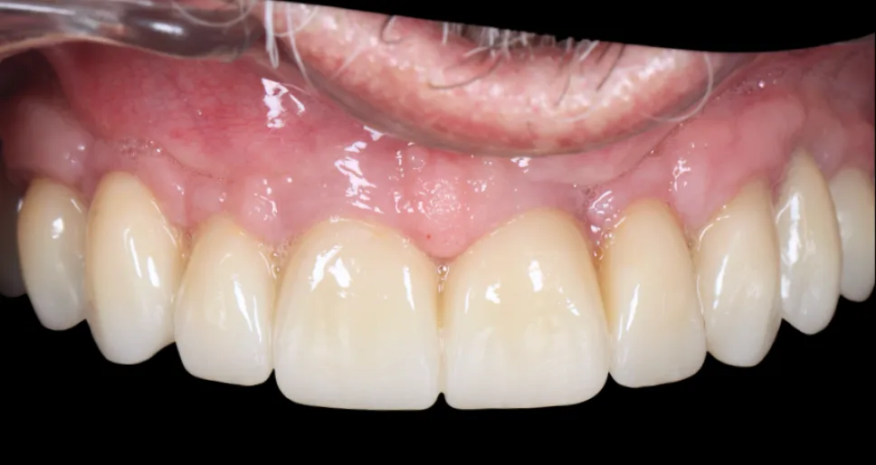 Patient avec une réhabilitation complète sur implant esthétique et fonctionnelle
