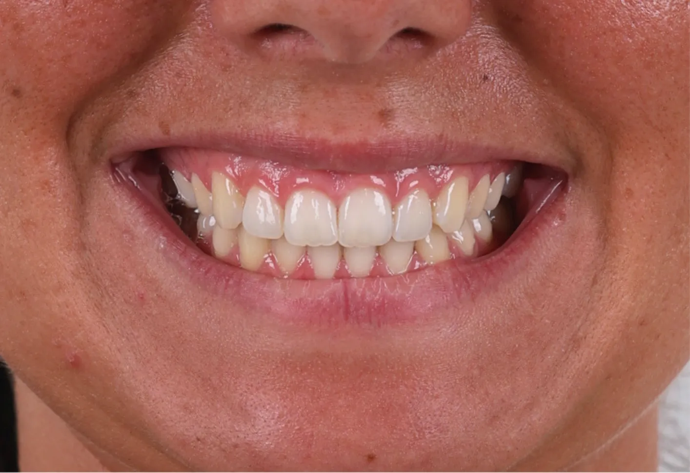 Patiente présentant un sourire gingival