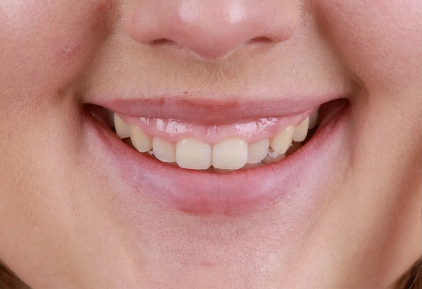 Patiente présentant un sourire gingival