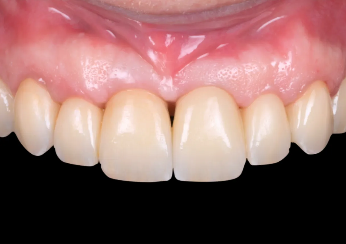 Patient avec une réhabilitation complète sur implant esthétique et fonctionnelle