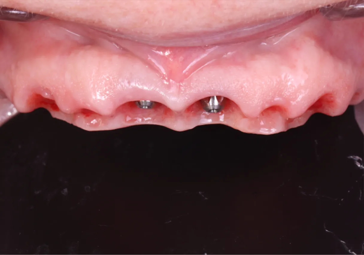 Patient présentant des implants dentaire sans les dents pour le moment