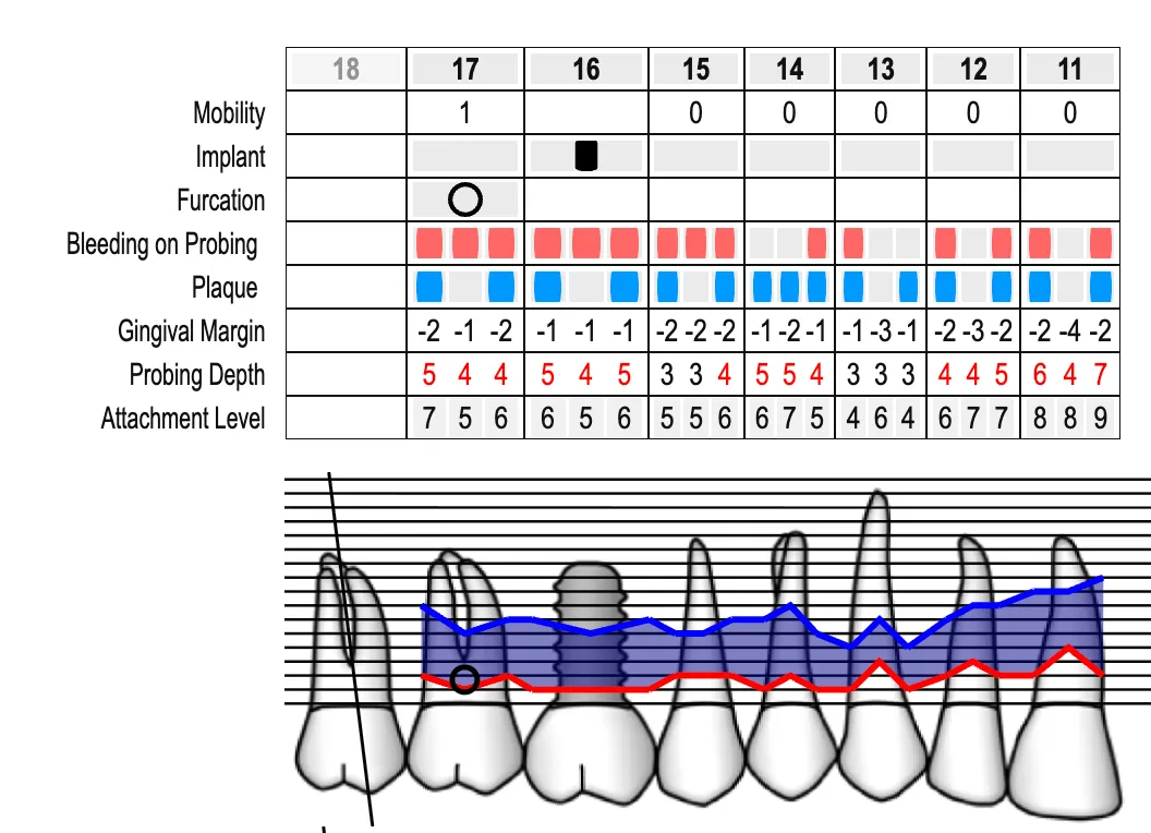 Charting parodontal avec des mesures permettant de poser un diagnostic.