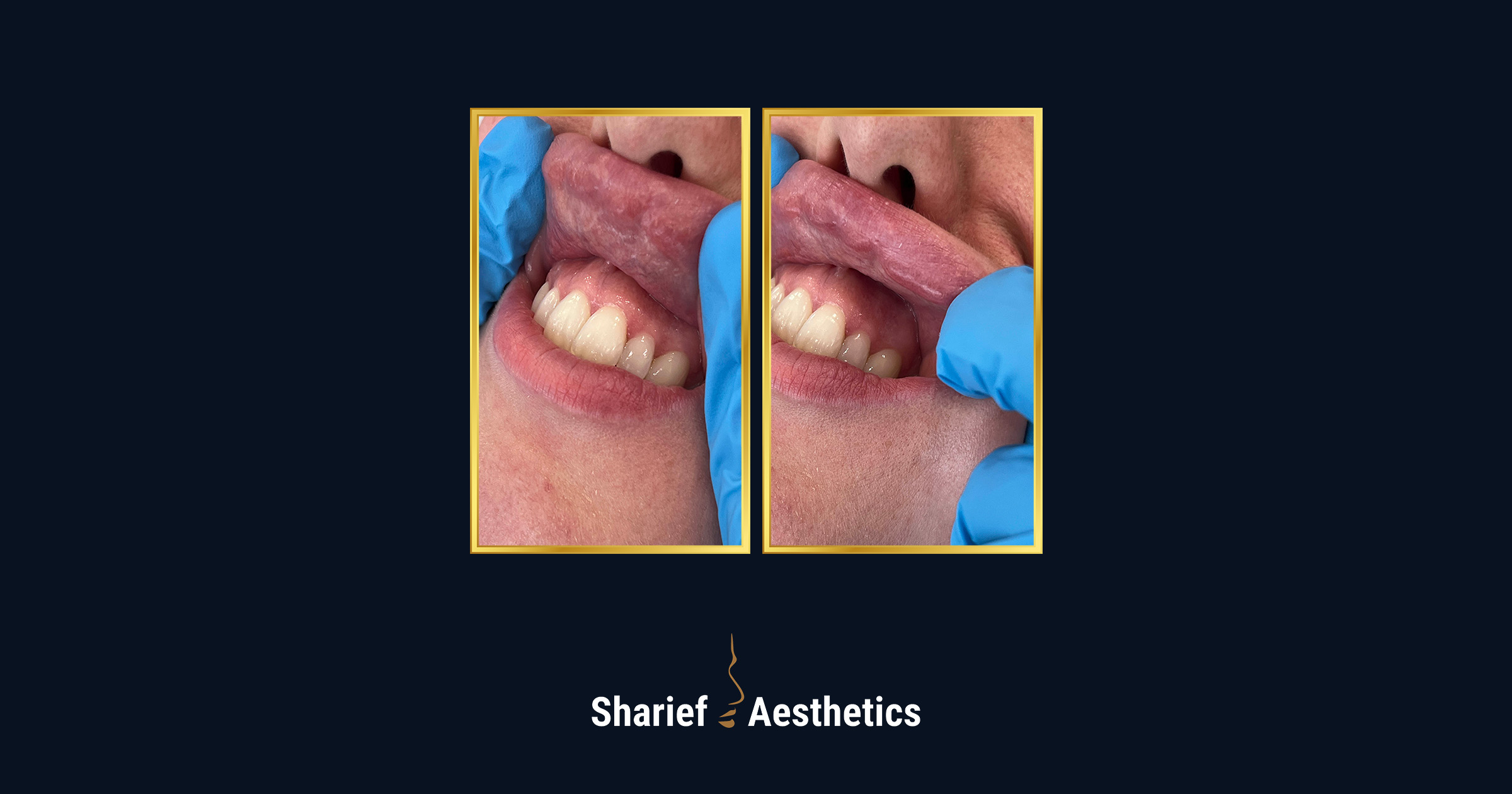 Clinical before photos demonstrating poorly placed lip filler from a previous provider, highlighting product migration outside the natural vermilion border requiring medical correction.