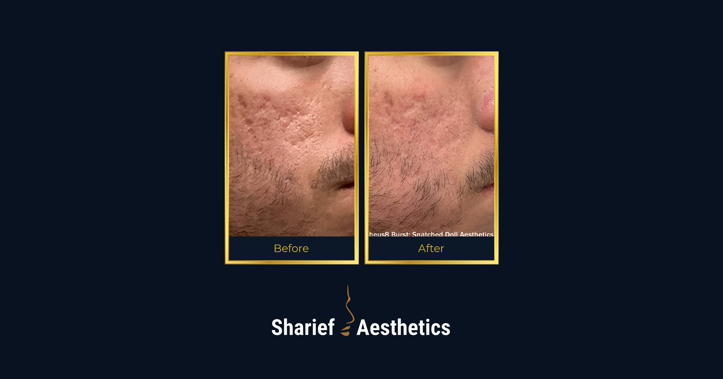 Clinical before and after photos demonstrating the visible reduction of stubborn acne scars and the improvement of overall skin texture using Morpheus8 fractional radiofrequency microneedling
