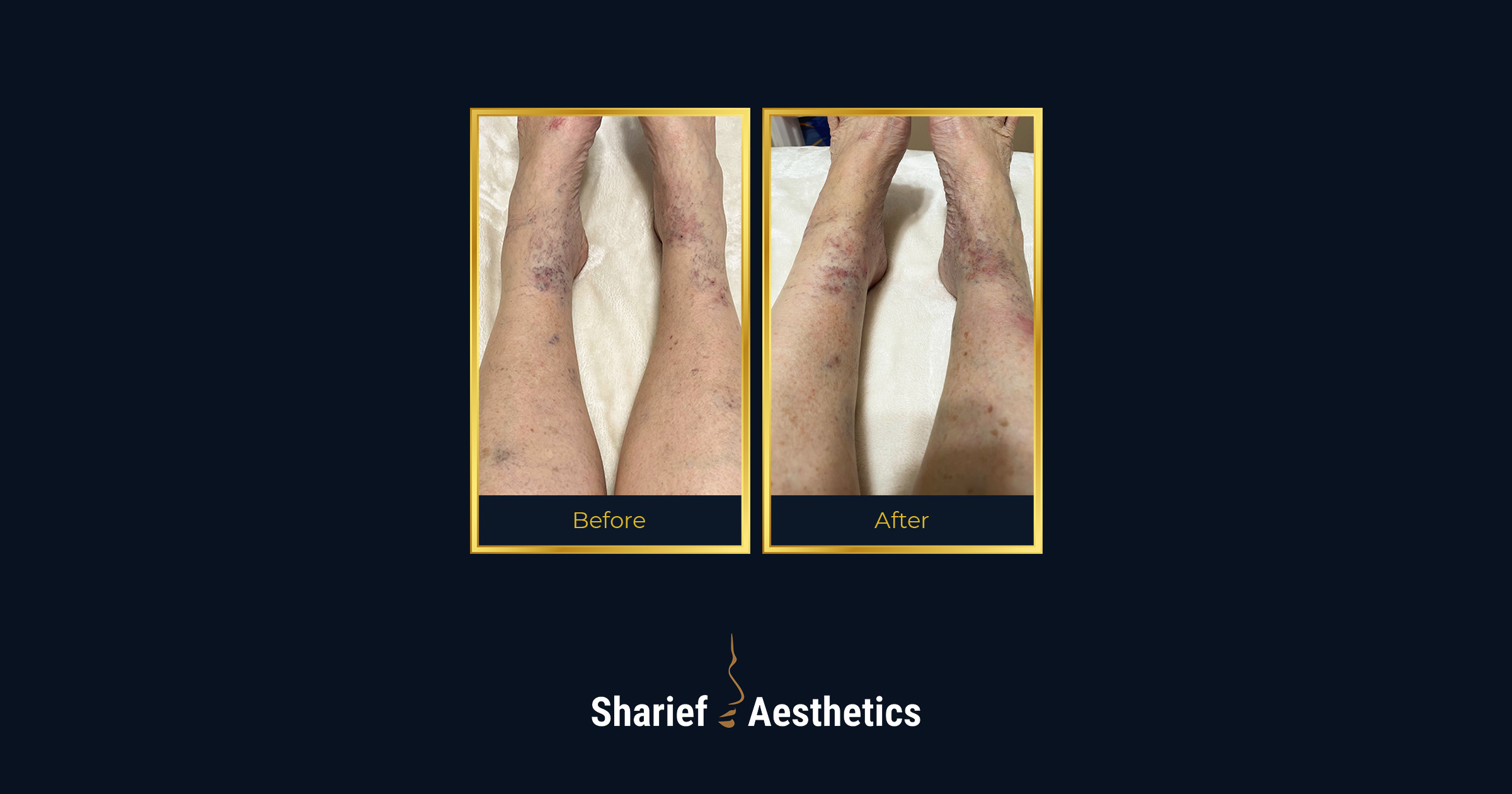 Clinical before and after photos showing the lower legs, demonstrating the successful fading and clearance of visible reticular and spider leg veins after Vasculaze laser treatment