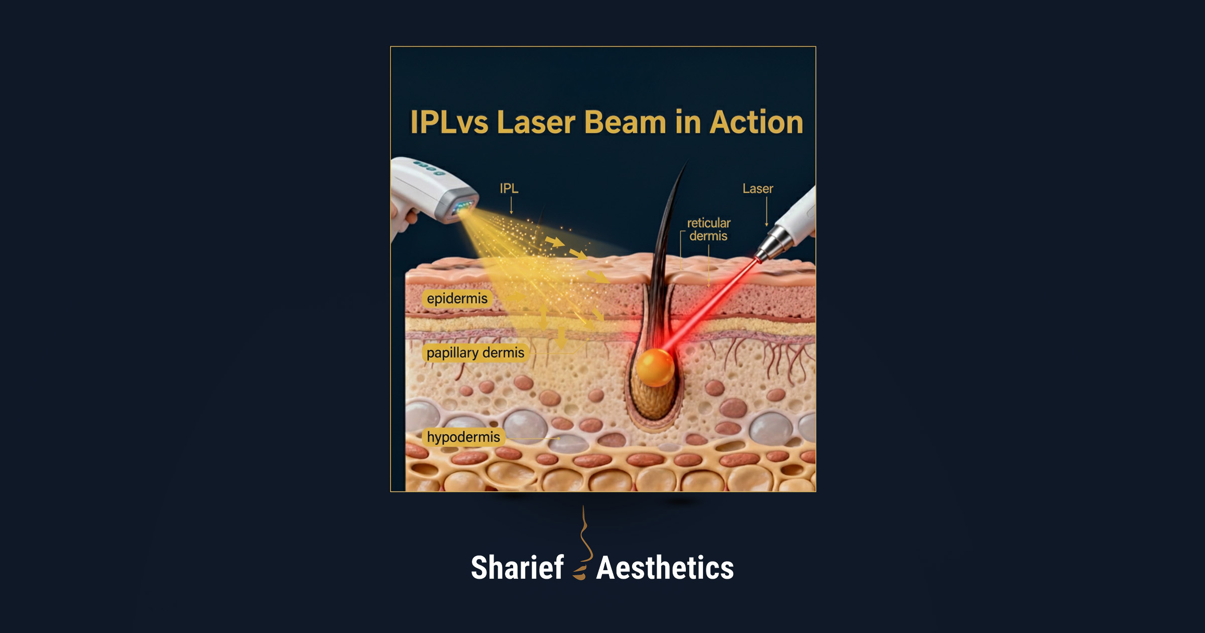 Anatomical cross-section demonstrating an IPL handpiece scattering light across the epidermis and papillary dermis, compared to a laser handpiece delivering a precise, concentrated beam directly to the hair bulb in the reticular dermis