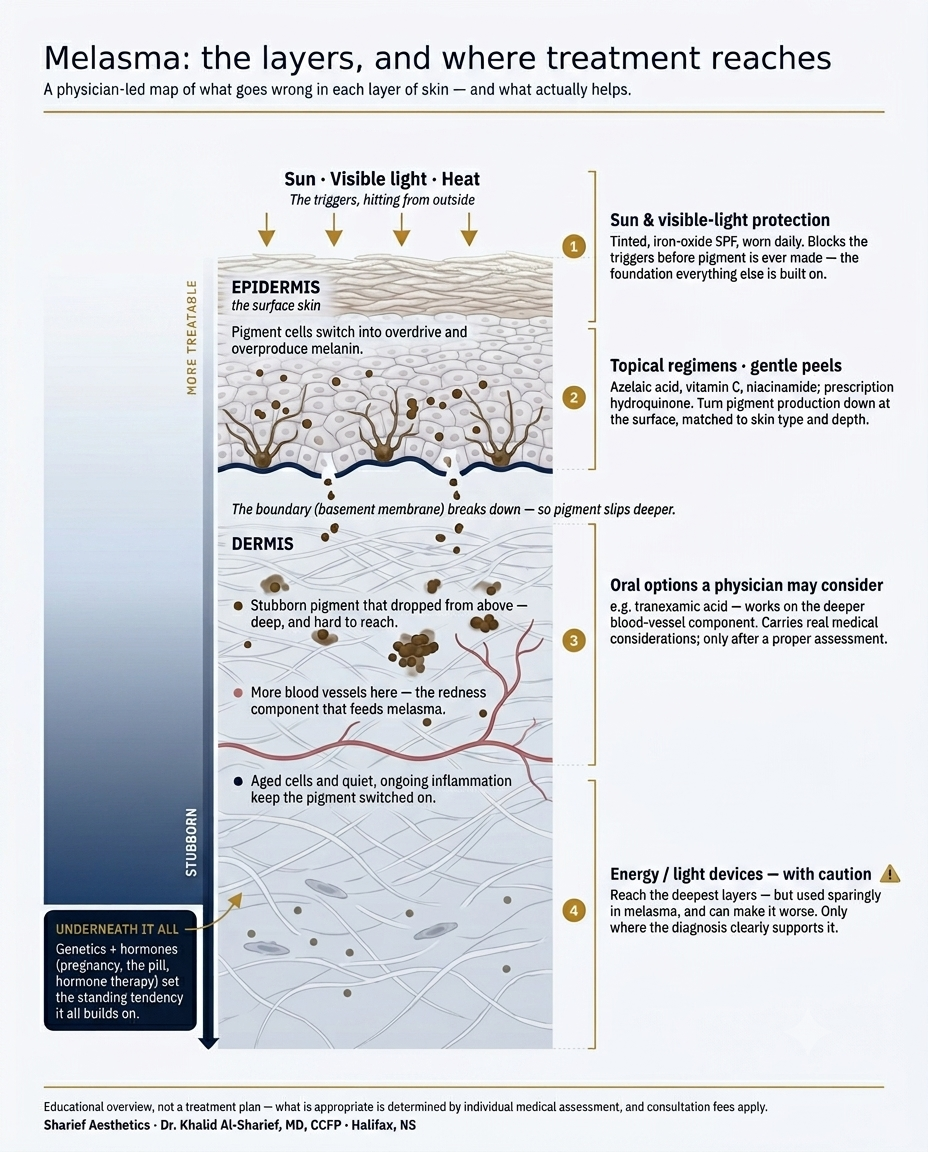 Cross-section diagram of skin showing melasma across the epidermis, basement membrane and dermis, with melasma treatments — sun protection, topical regimens, oral options and energy devices — mapped to the depth each one reaches.