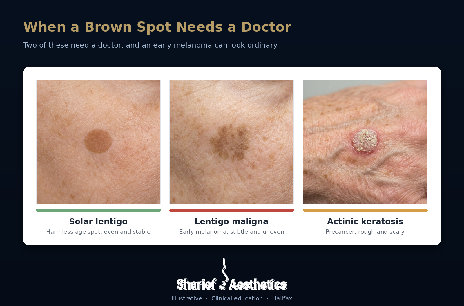 Three brown-spot lookalikes as illustrative clinical figures: a harmless solar lentigo, an early lentigo maligna melanoma, and a hypertrophic actinic keratosis. Sharief Aesthetics, Halifax.