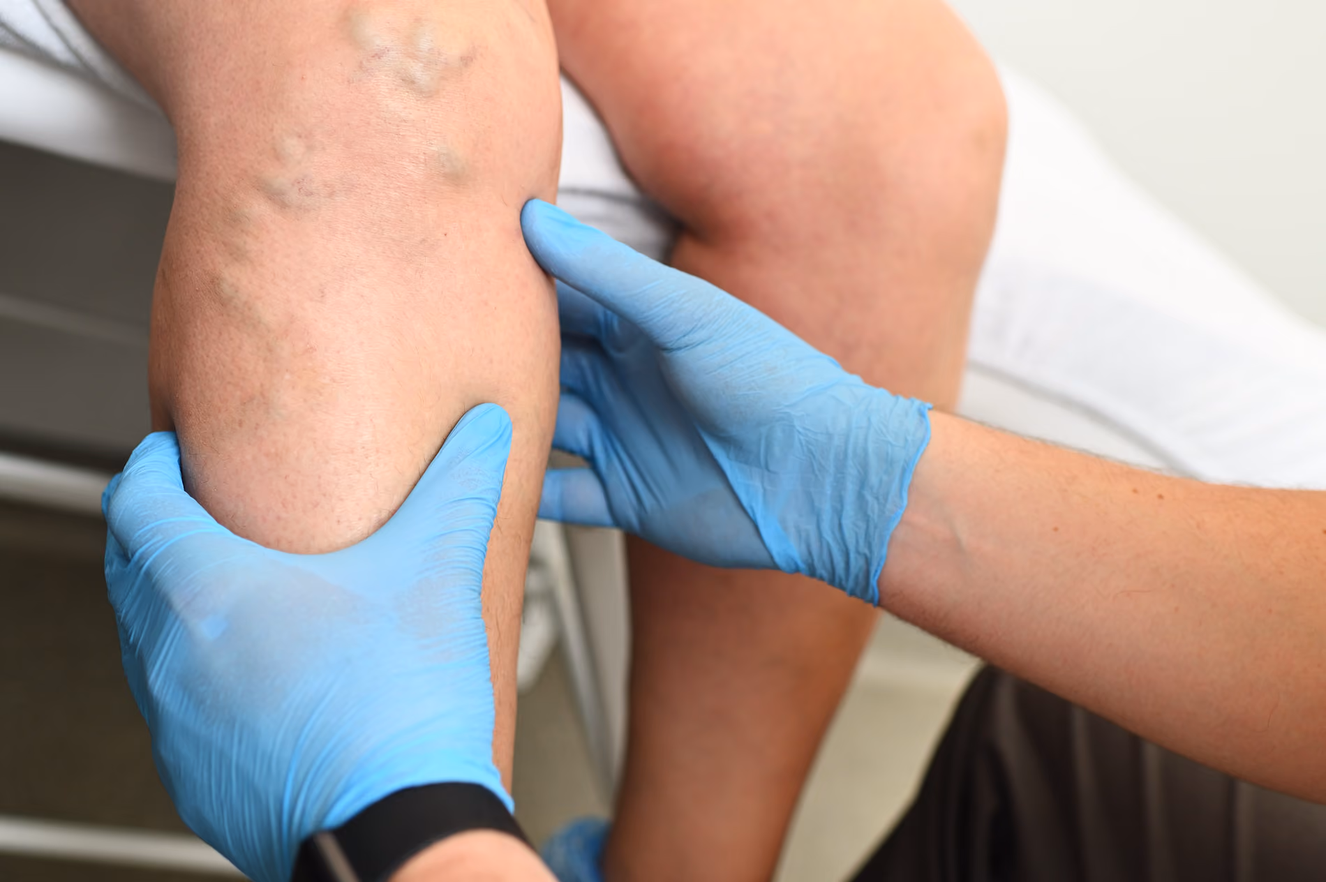Untersuchung eines Lymphödems am Bein vor der Manuellen Lymphdrainage