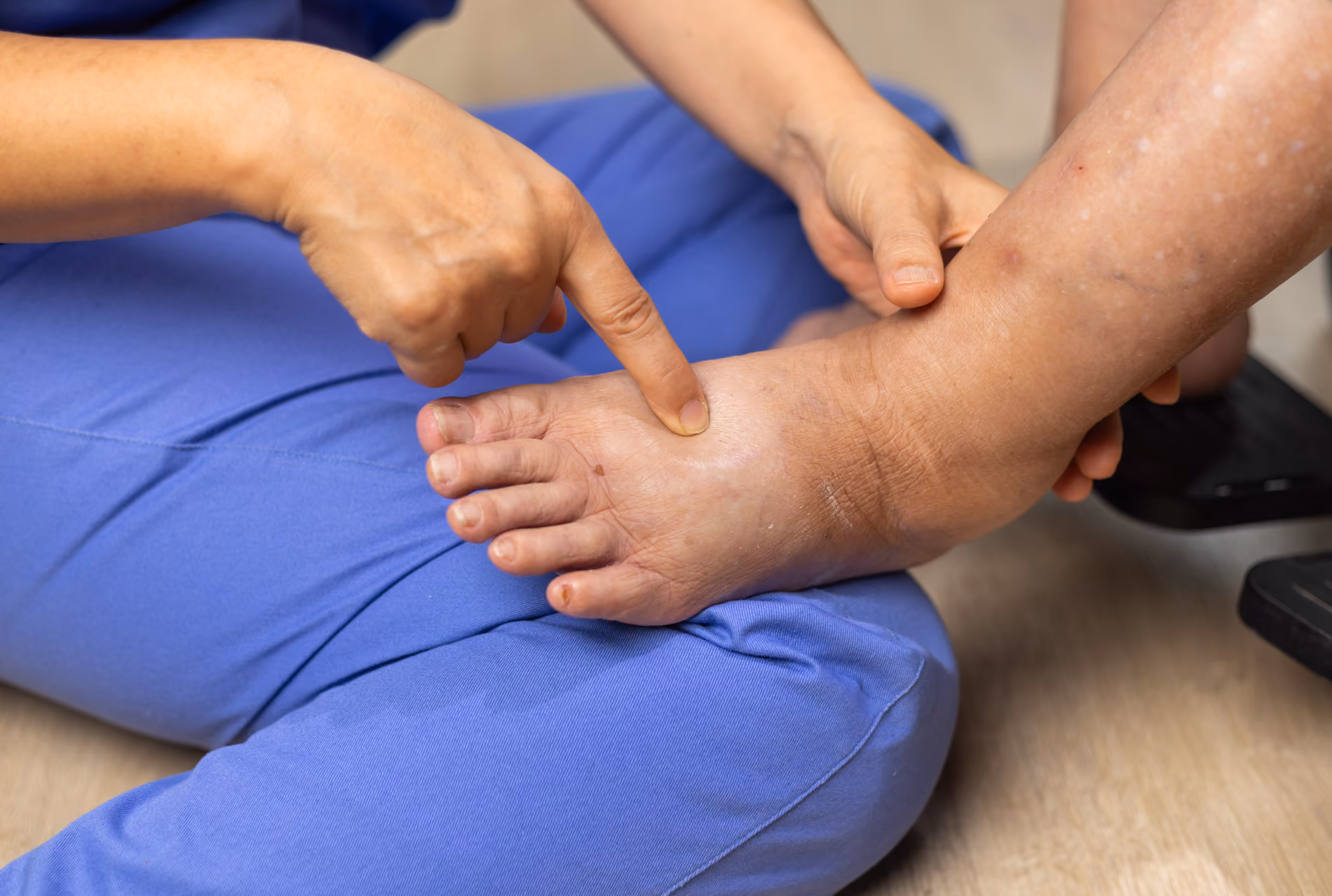 Untersuchung der Beine bei Lipödem vor der Lymphdrainage im Raum Würzburg