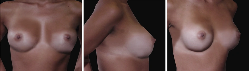 Breast Augmentation